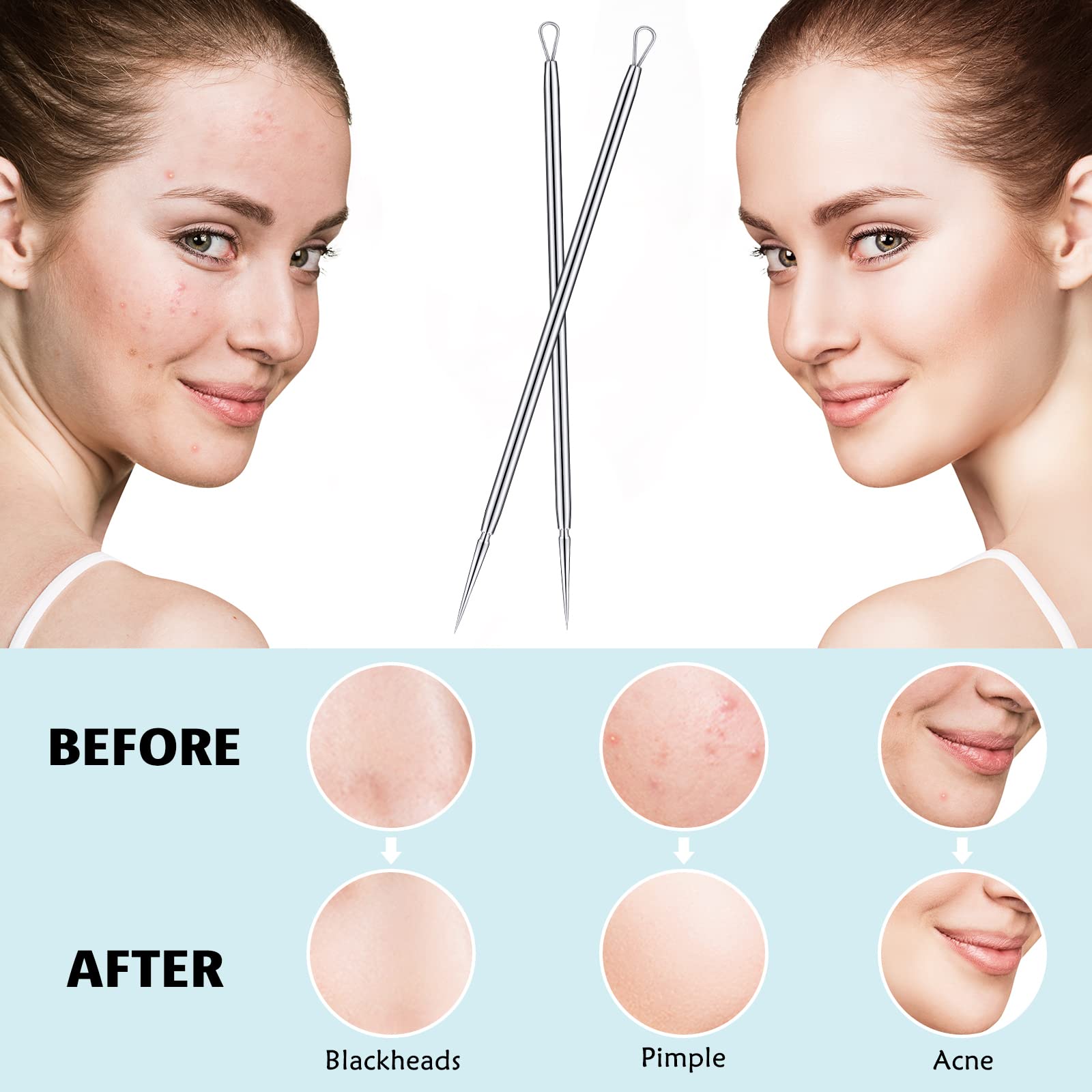 Titanium Lancet Needle Pimple Popper Tool Facial Milia Remover Blackhead Blemish Remover Blackhead Whitehead Extractor Professio