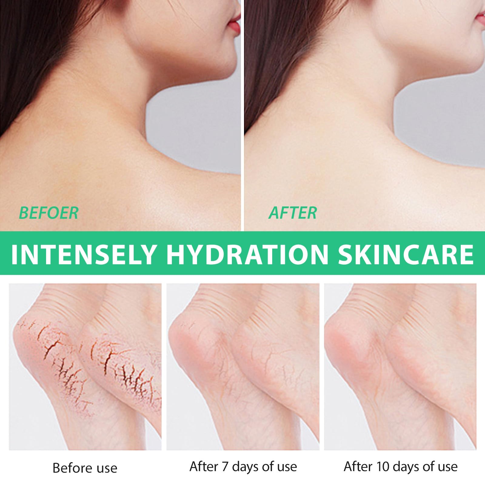 Urea Cream 40 Percent For Feet Maximum Strength,40% Urea Cream Plus 2% Salicylic Acid With Hyaluronic Acid,Tea Tree,And Aloe Ver