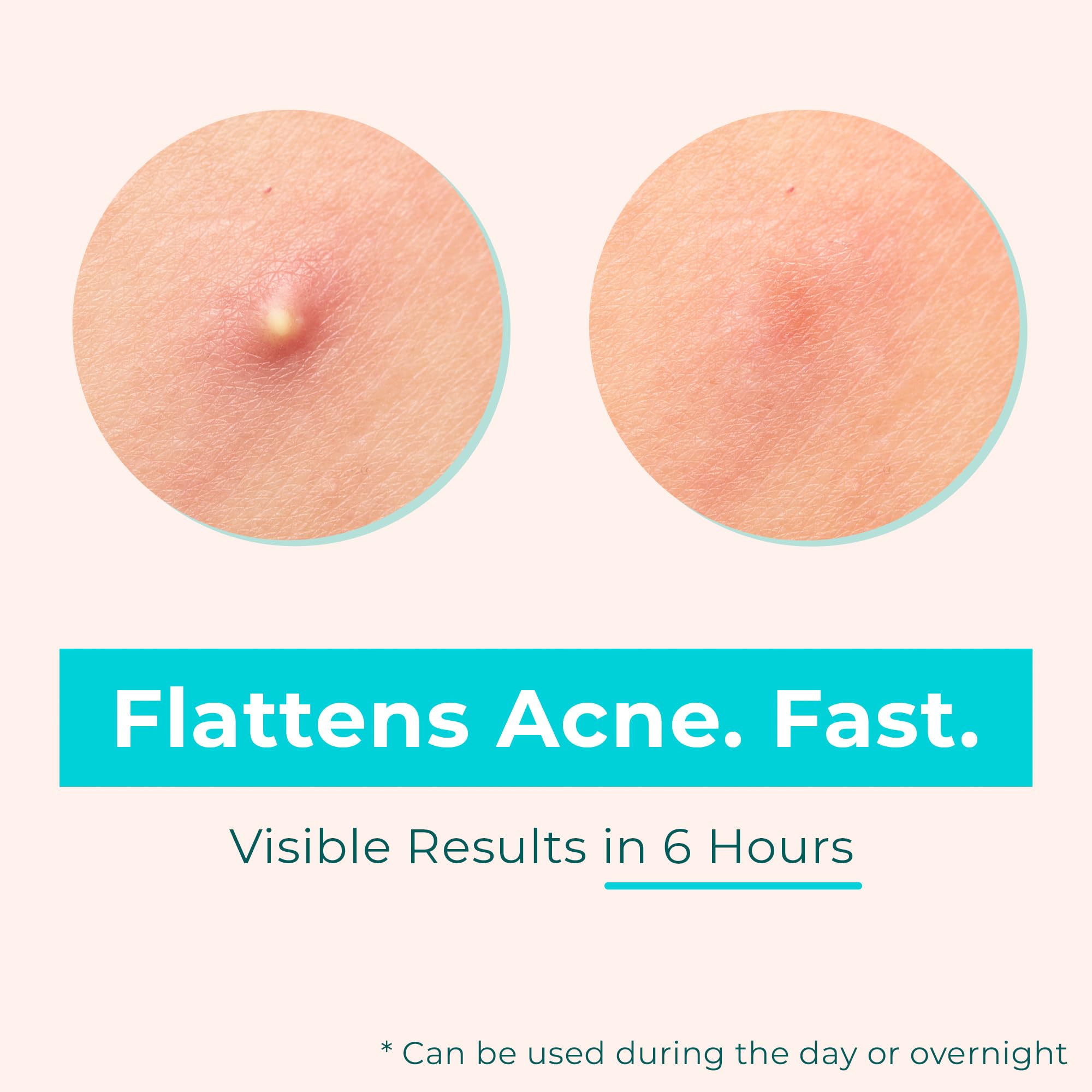 Pimple Patches for Face & Body - Overnight Treatment - Acne Patch for Zits, Dots, Bumps, Spots, Pimples, Whiteheads - Hydrocollo