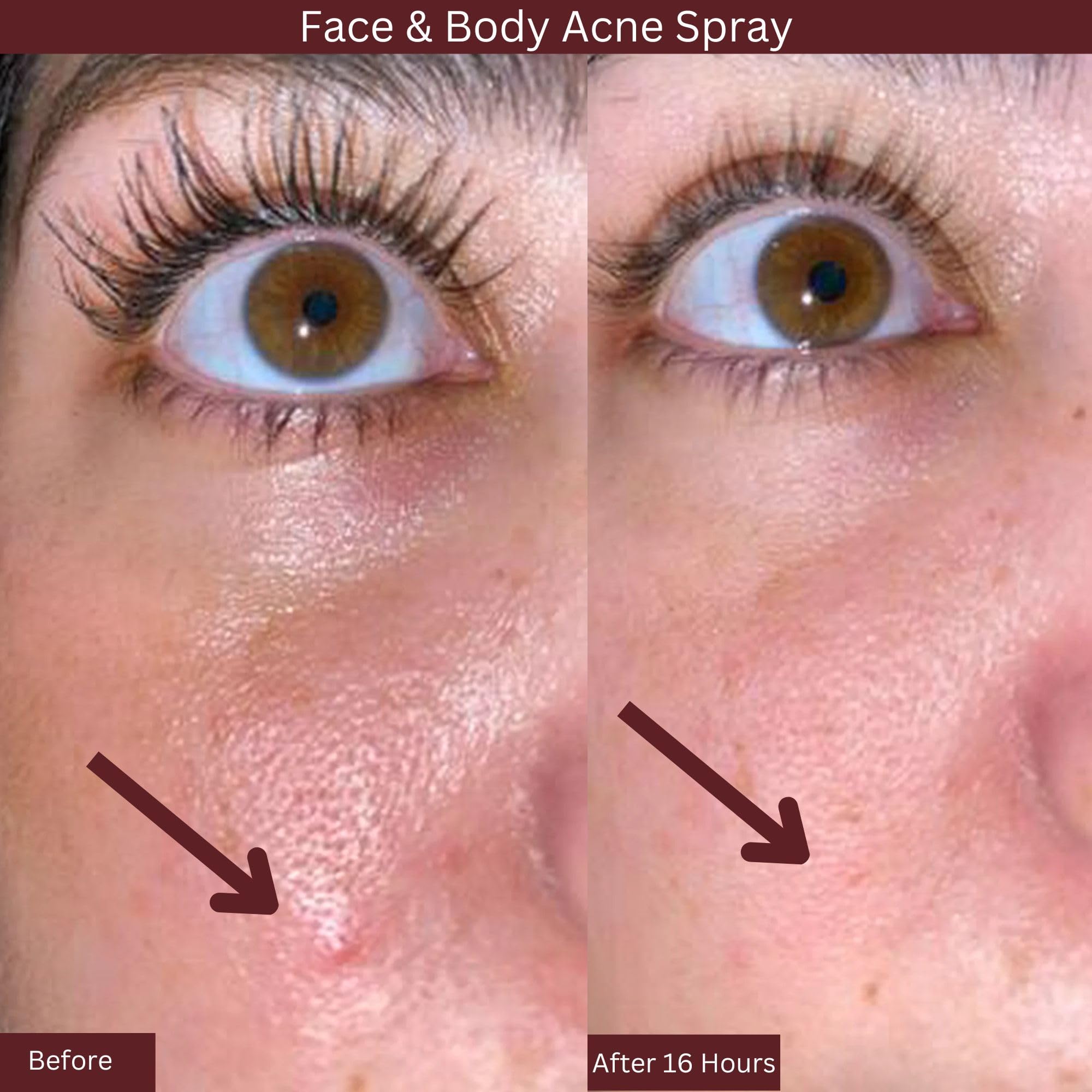 ITK Skincare 2% Salicylic Acid Spray - Acne Treatment for Face & Body, 3.3oz, Clear Blemish Mist for Post Workout