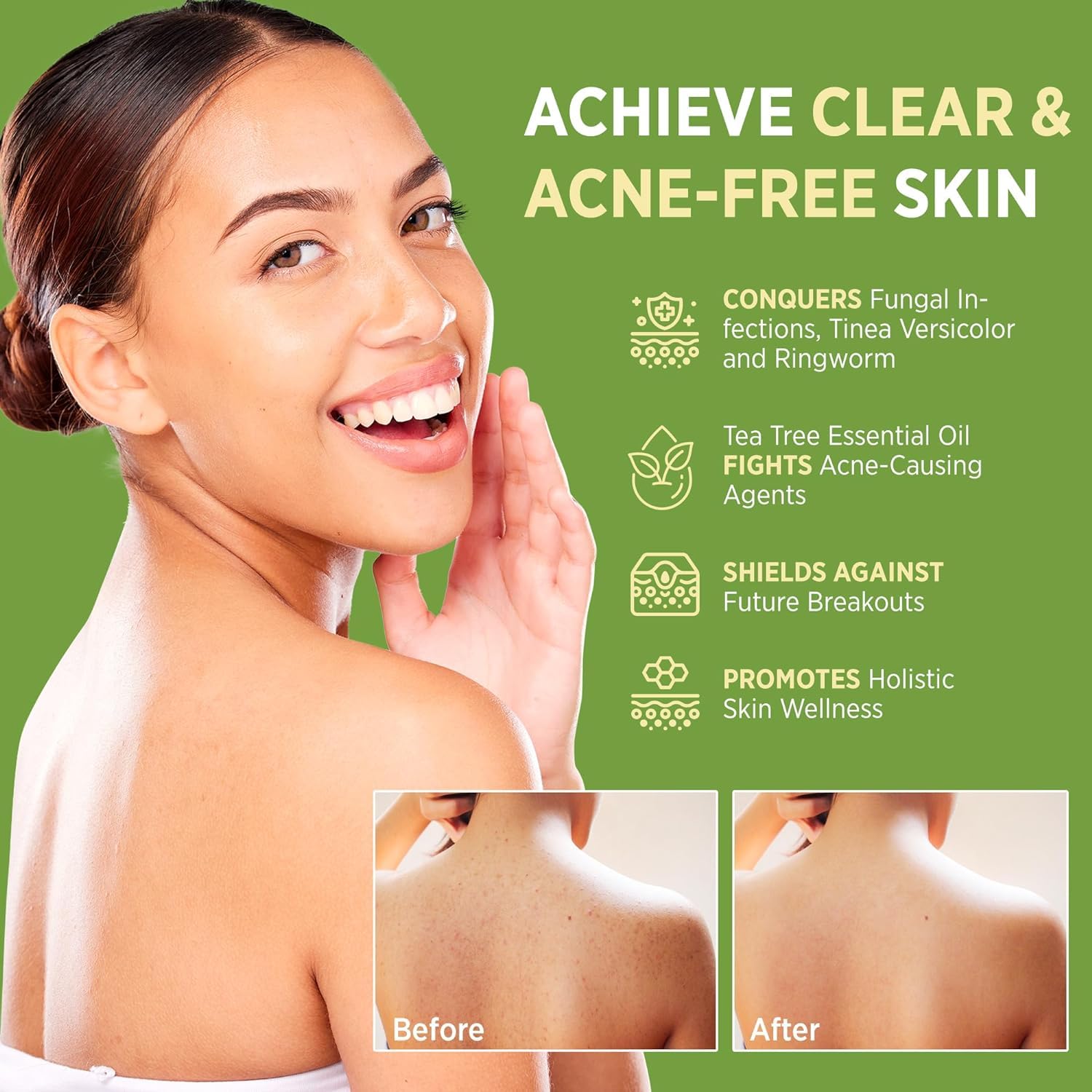 Roycederm Tea Tree Soap - Antifungal & Antibacterial Treatment for Acne, Athlete's Foot - 4 oz, Pack of 1