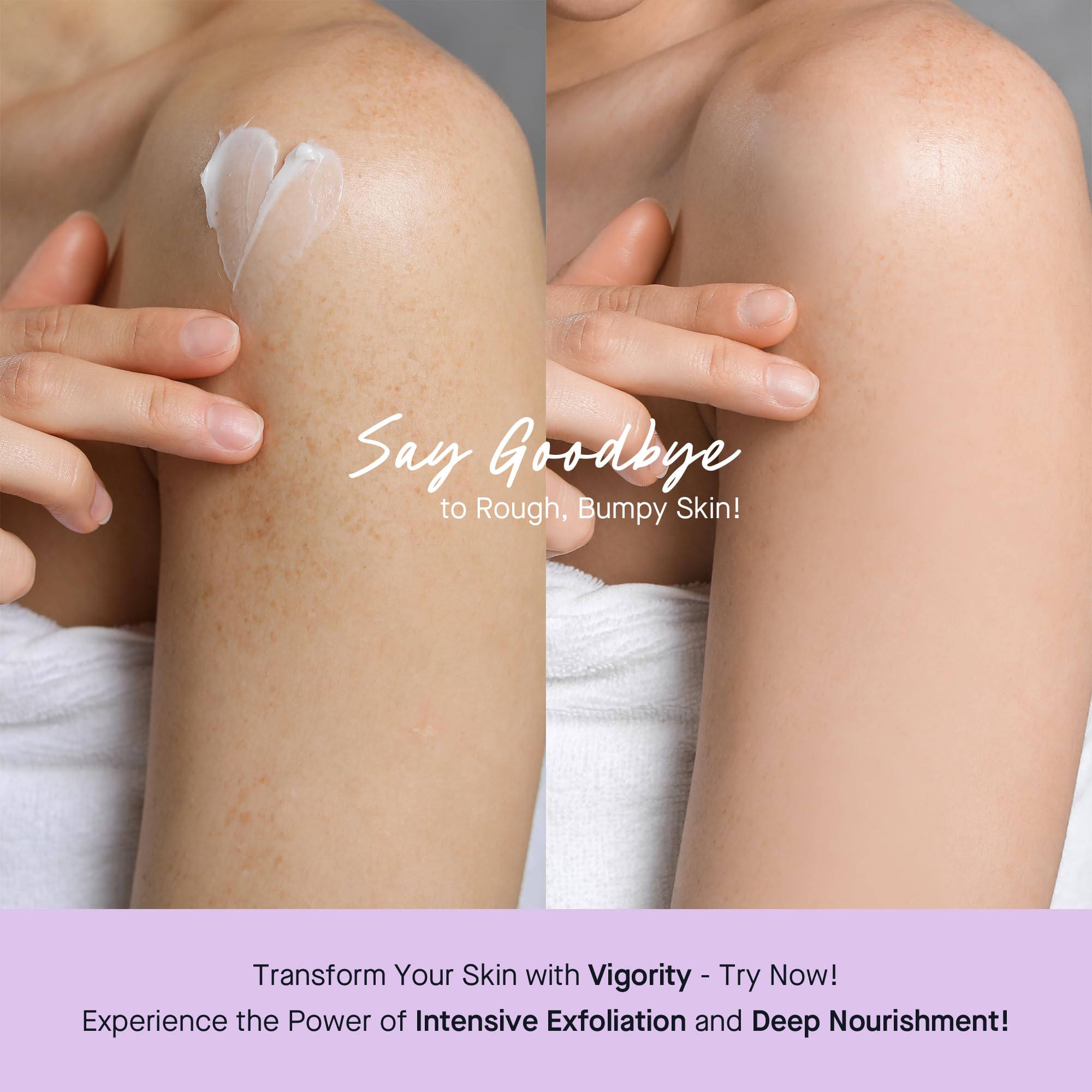 Vigority Keratosis Pilaris Treatment Cream with Lactic Acid - KP Body Bump Exfoliating Moisturizer for Rough, Bumpy, Dry & Flake