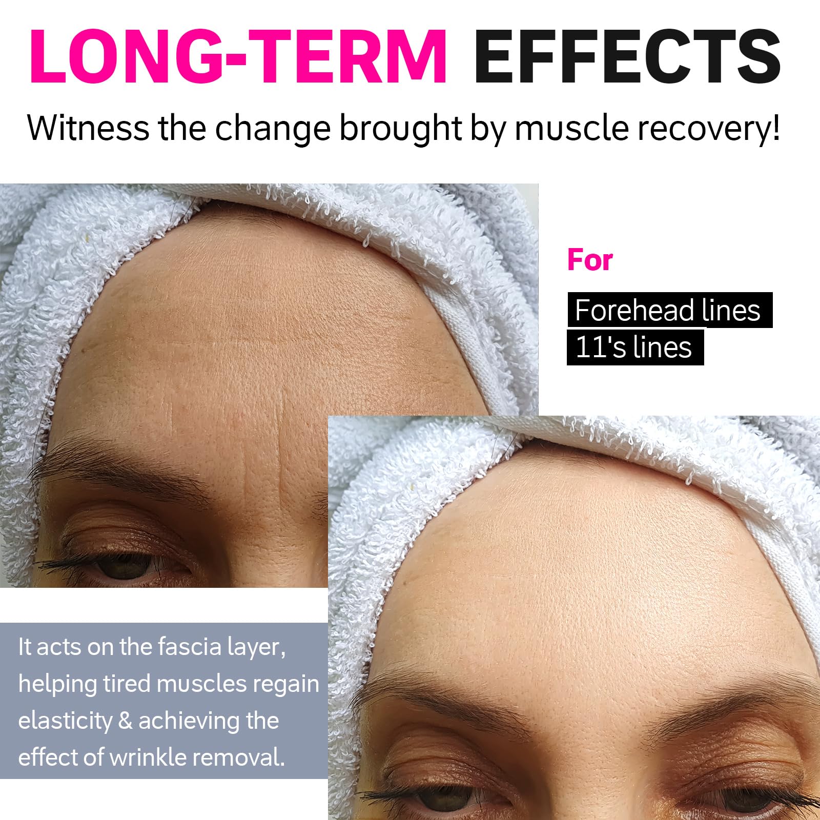 Akissos Forehead Wrinkle Patches 15 Pcs Kinesiology Face Tape For Wrinkles Overnight, Precut Facial Patches For Forehead Wrinkle