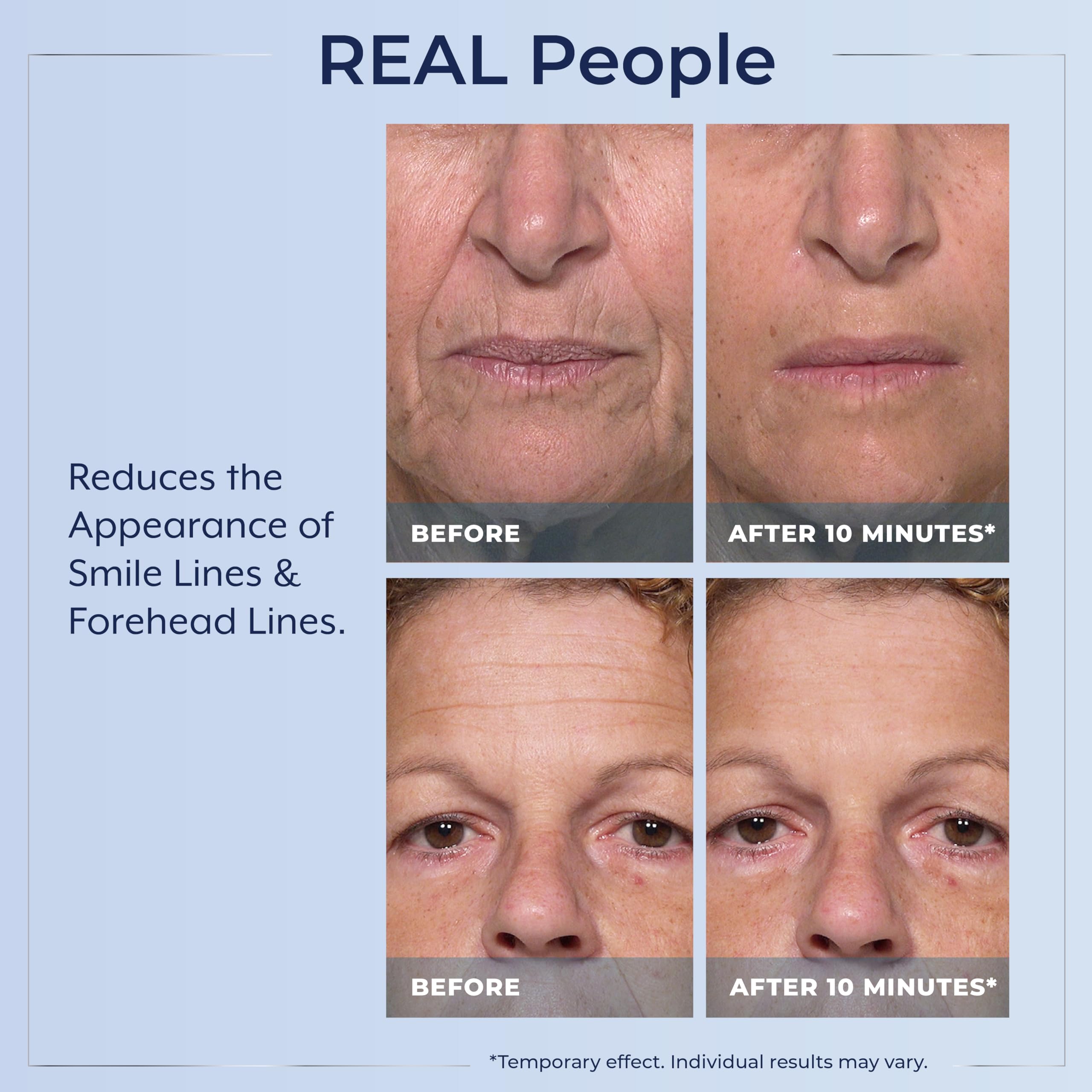 Plexaderm Rapid Reduction Eye Serum - Reduces Under-Eye Bags, Wrinkles & Dark Circles - 0.17 Fl Oz