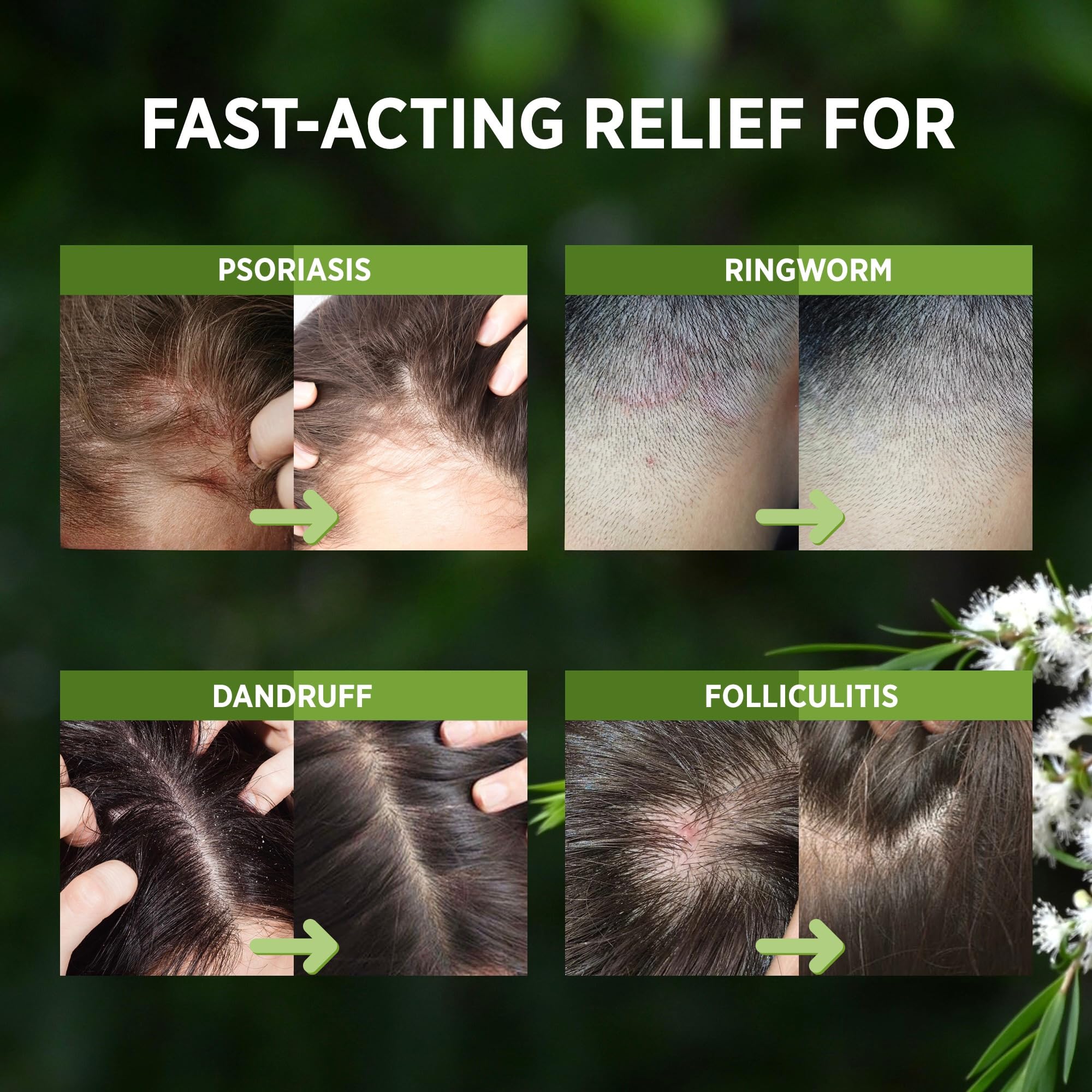 RoyceDerm Tea Tree Scalp Relief Spray: Leave-In Scalp Care for Dry, Flaky, and Itchy Scalp - Tea Tree Oil Formula for Comfort, H