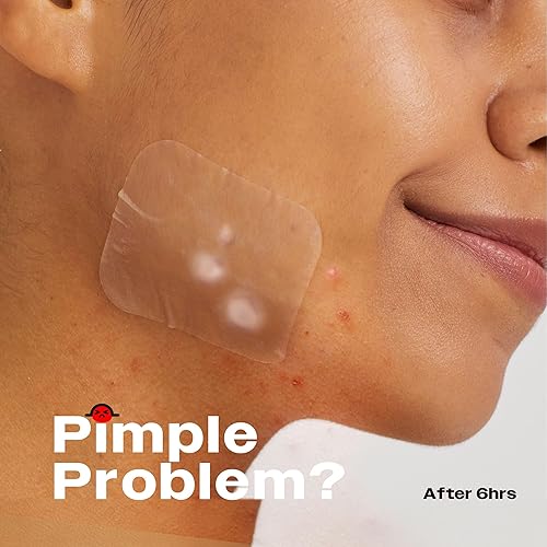 AVARELLE Acne Patches XL - Large Hydrocolloid Treatment with Tea Tree, Calendula & Cica - 8 Count for Face, Cheek & Nose