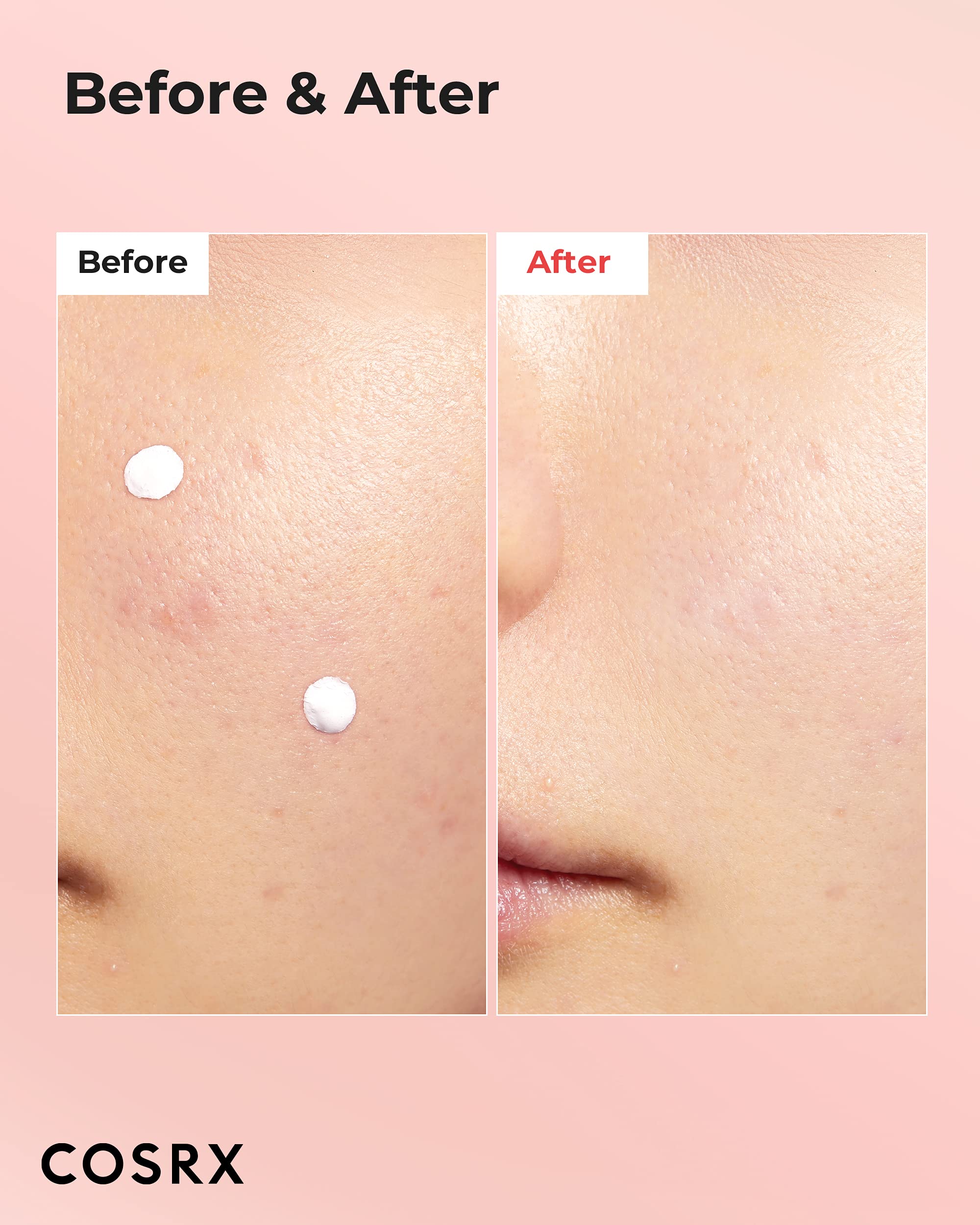 Cosrx Acne Blemish Spot Drying Lotion 1.01 Fl. Oz / 30Ml Dry And Reduce Blemish Spot, Pimple, Whitehead, Spot Treatment, Korean