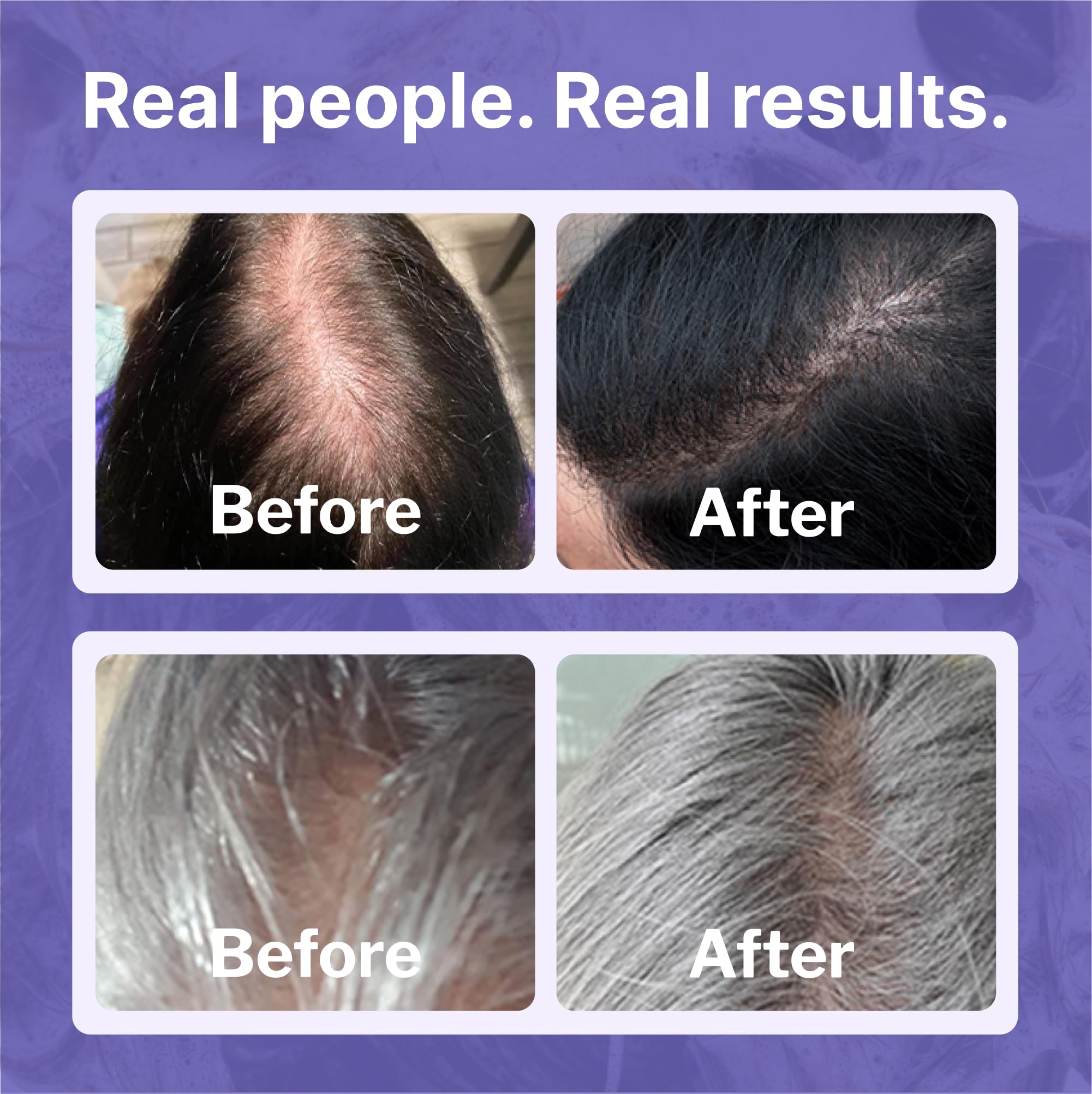 Minoxidil 2% Topical Solution for Women's Hair Growth, Serum Promotes Hair Regrowth by Reactivating Hair Follicles | Shapiro MD