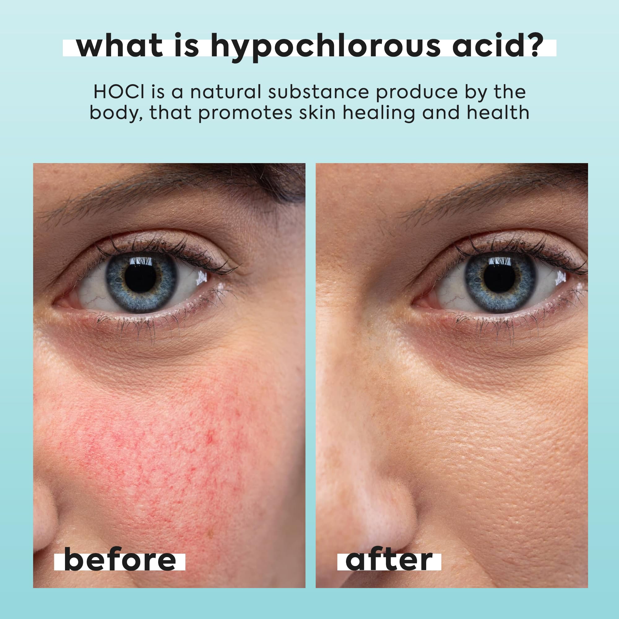 2 Pack Hypochlorous Acid Spray for Face & Body - 2 x 3.4 fl oz - Helps Reduce Redness and Breakouts - Multi-Purpose Travel Size