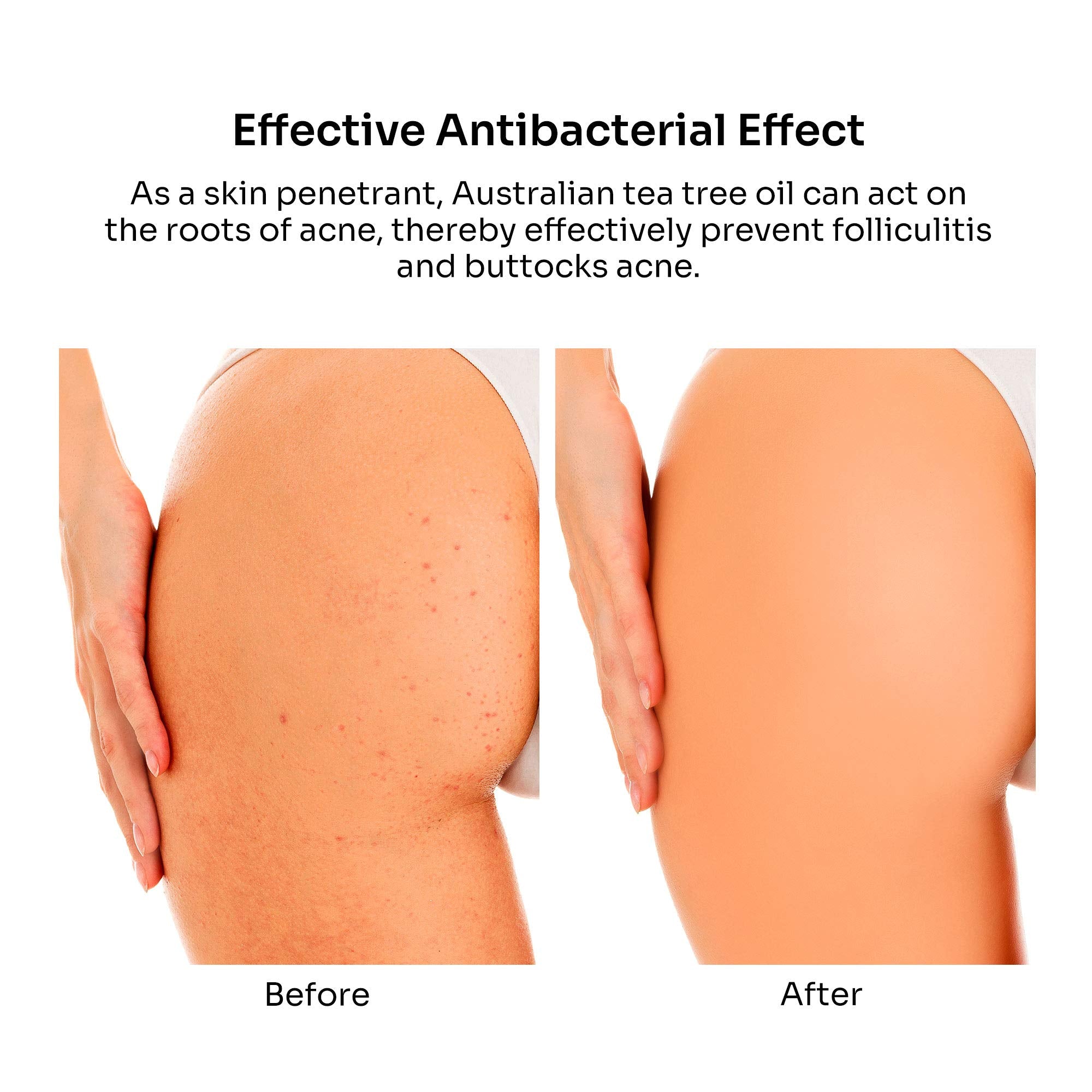 BellamiLuxx Butt Acne clearing Lotion, Pure Plants Extracts for Reduce Acne and Pimples, Balance Skin MoistureSebum, Keep Buttoc