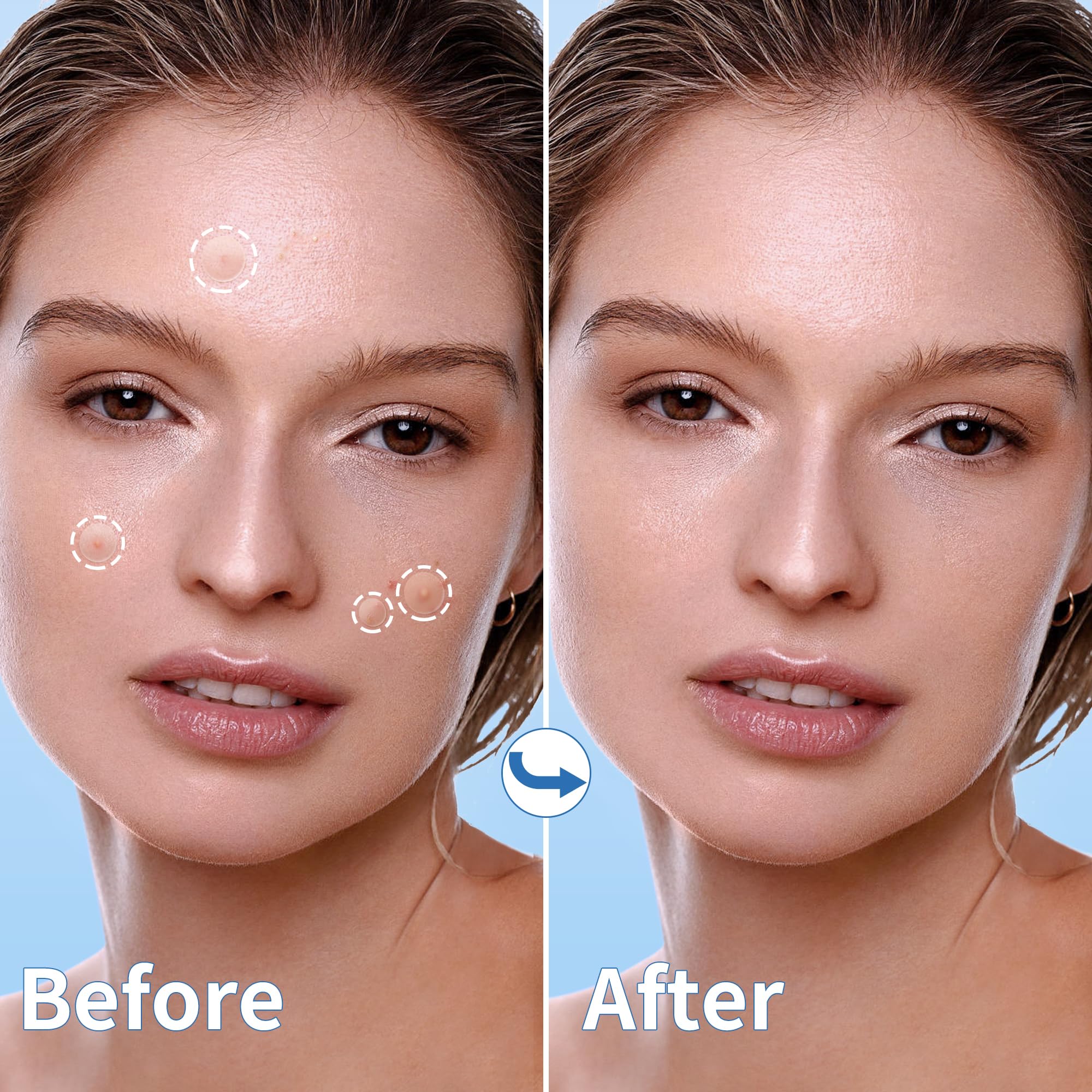 Daolyo Pimple Patches For Face, 4 Size 300 Counts Acne Patches, Hydrocolloid Patches For Covering Zits And Blemishes, Spot Stick