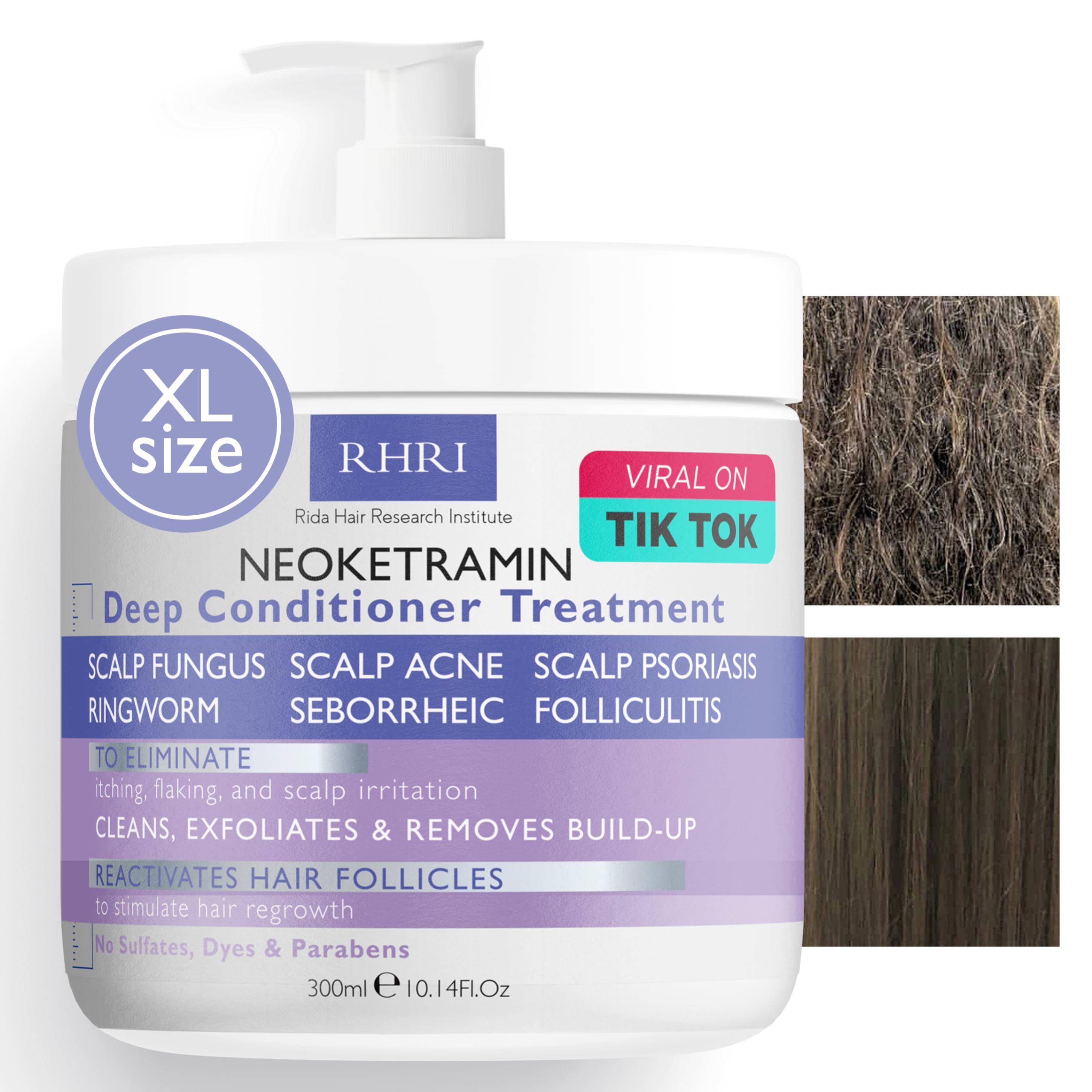 Anti Fungal Deep Conditioner for Men and Women | Scalp Treatment for Psoriasis, Dandruff, Seborrheic Dermatitis | Provides Relie