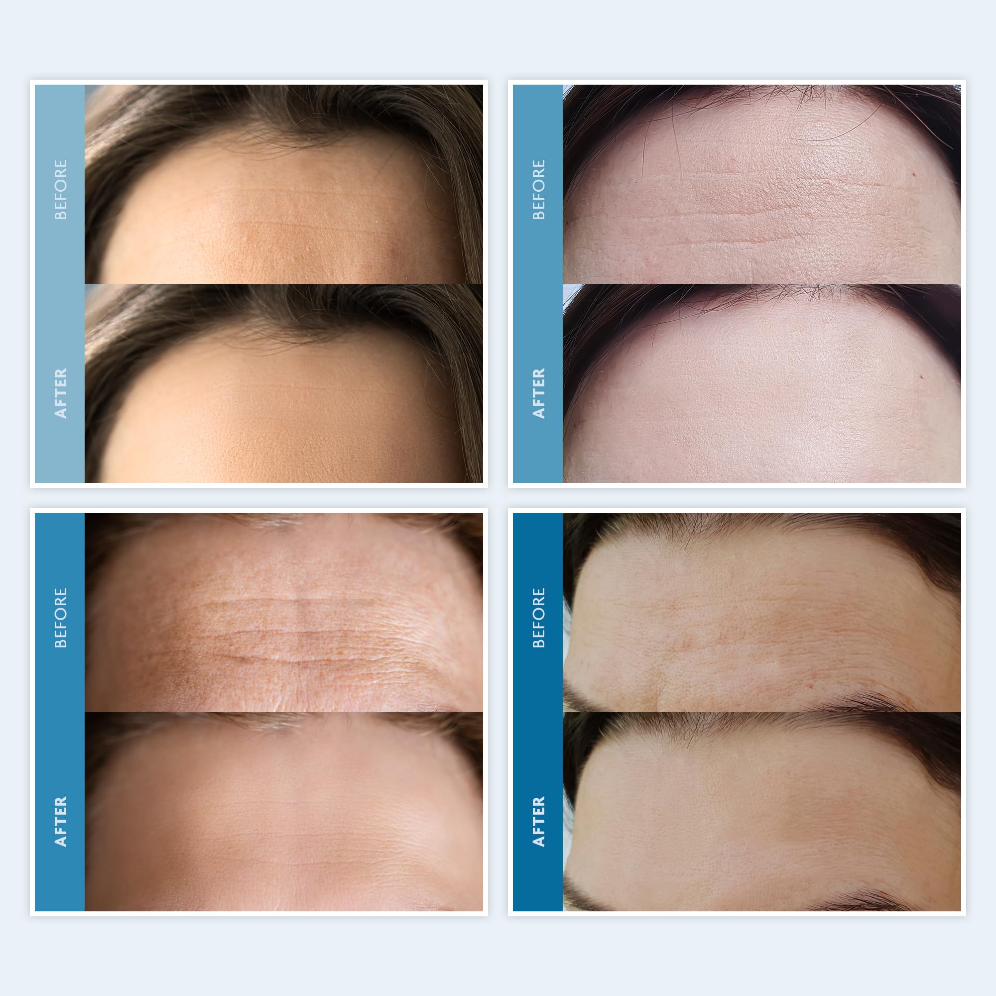 Dersie Silicone Forehead Wrinkle Patches: Reusable Silicone Anti Wrinkle Patches - Forehead Wrinkles Treatment - Overnight Use F