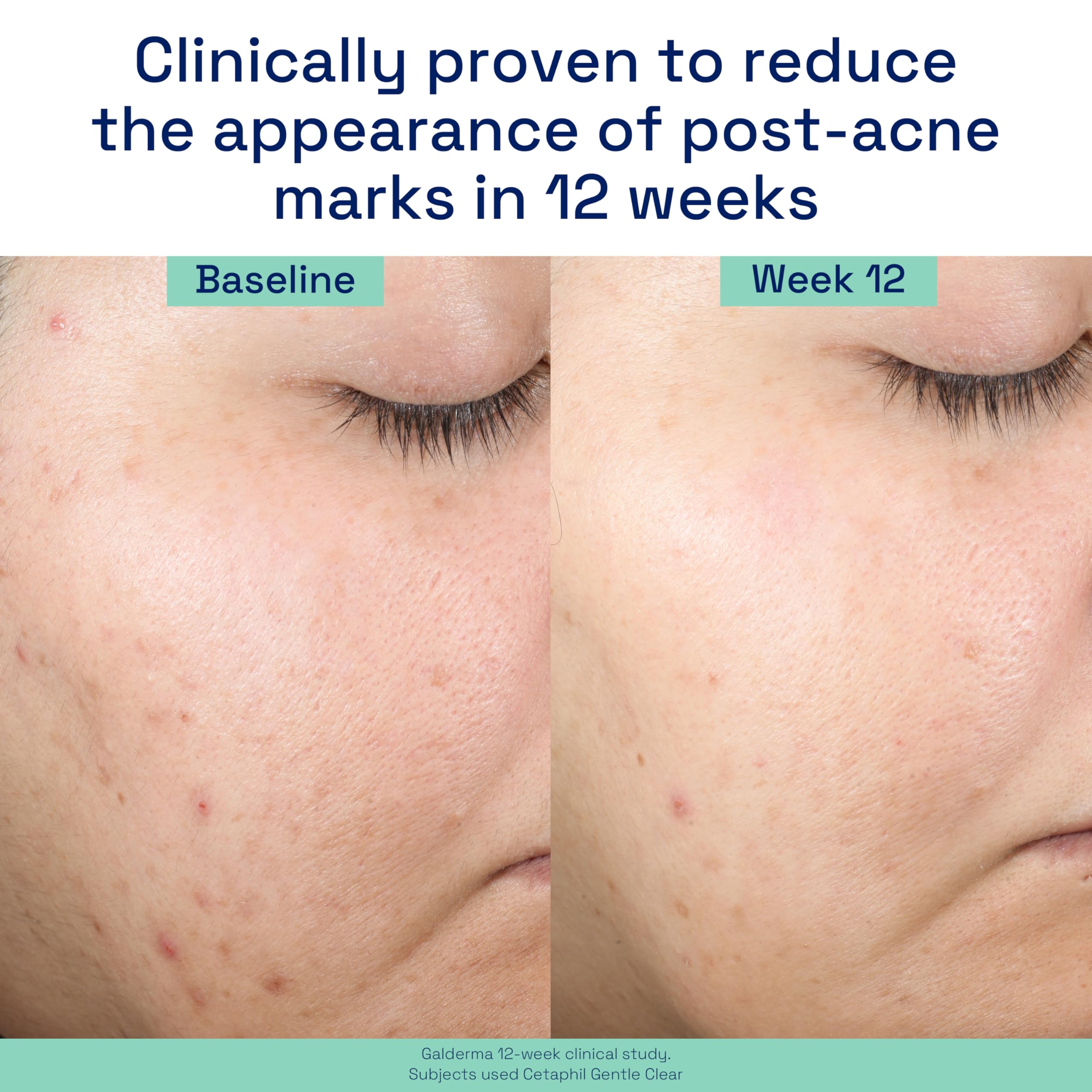 Cetaphil Gentle Clear Post-Acne Serum, Oil-Free Bakuchiol Formula, 1 Fl Oz, Dermatologist Recommended for Sensitive Skin