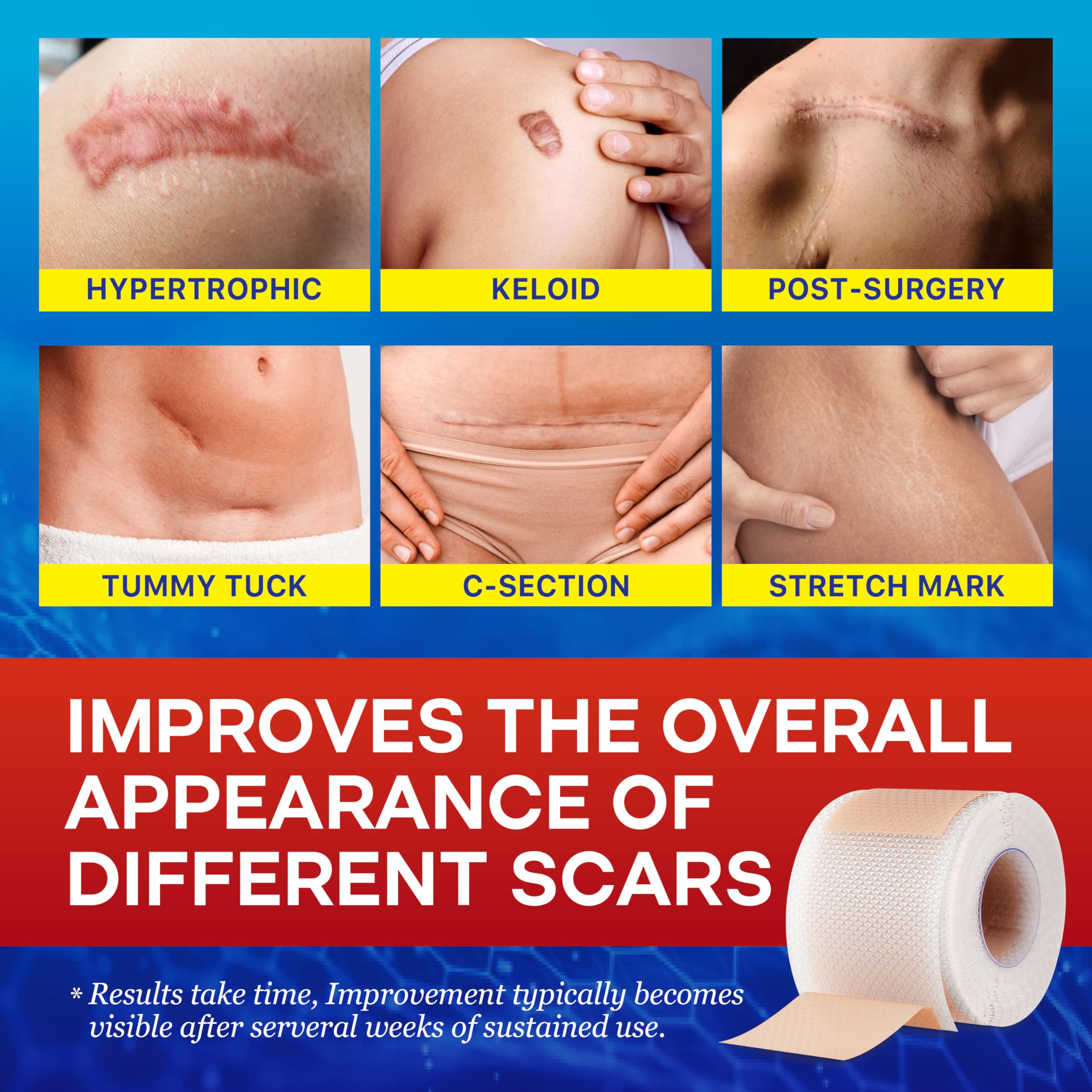 1.6''X 120'' Medical Silicone Scar Tape For Scars: Medical Grade Scar Sheets Reduces The Appearance Of Scars From Surgical Acne