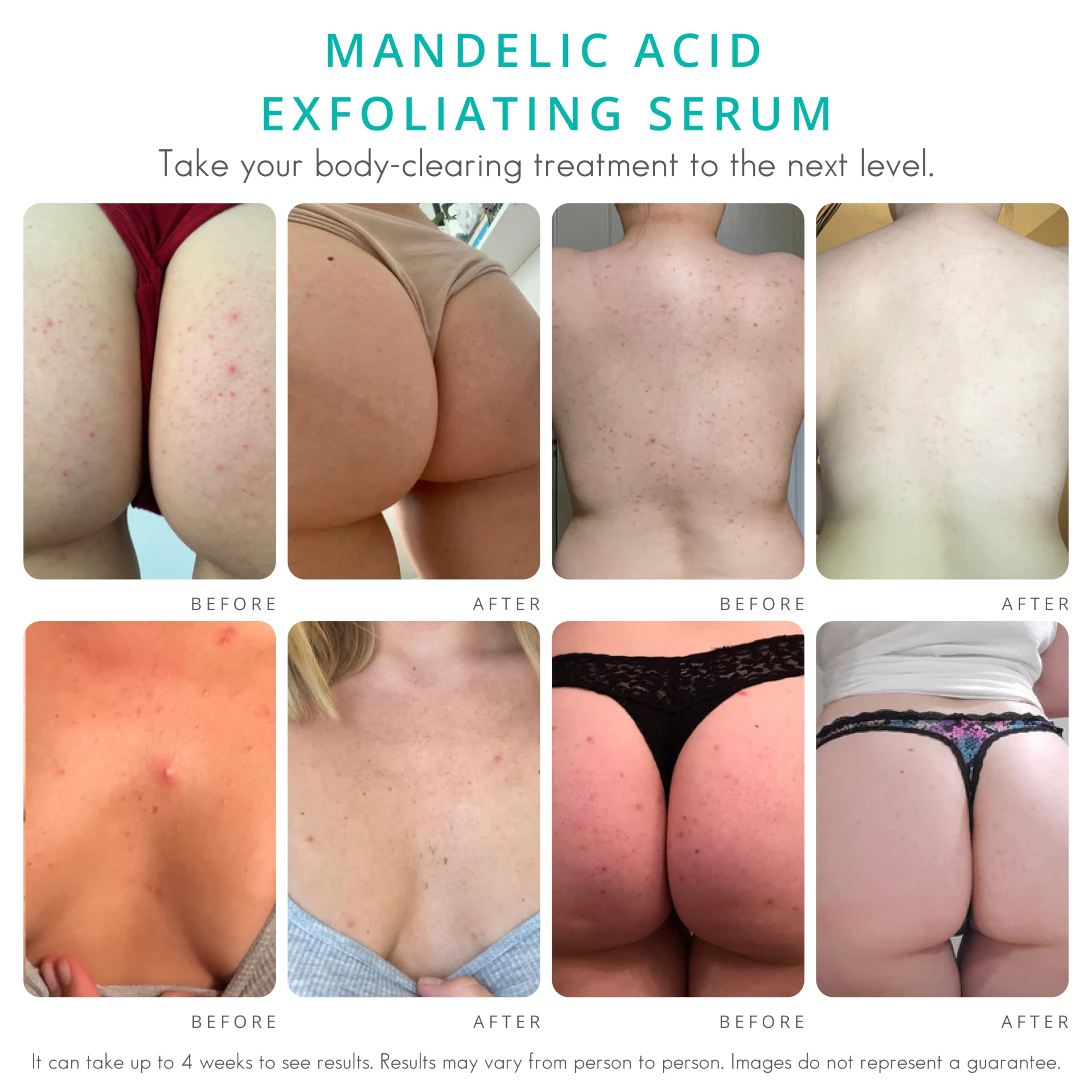 Almond Clear Level 2 Serum | Mandelic Acid Body Serum for Acne, Folliculitis, Aging Skin, Ingrown Hairs, Dark Spots on Face, Che