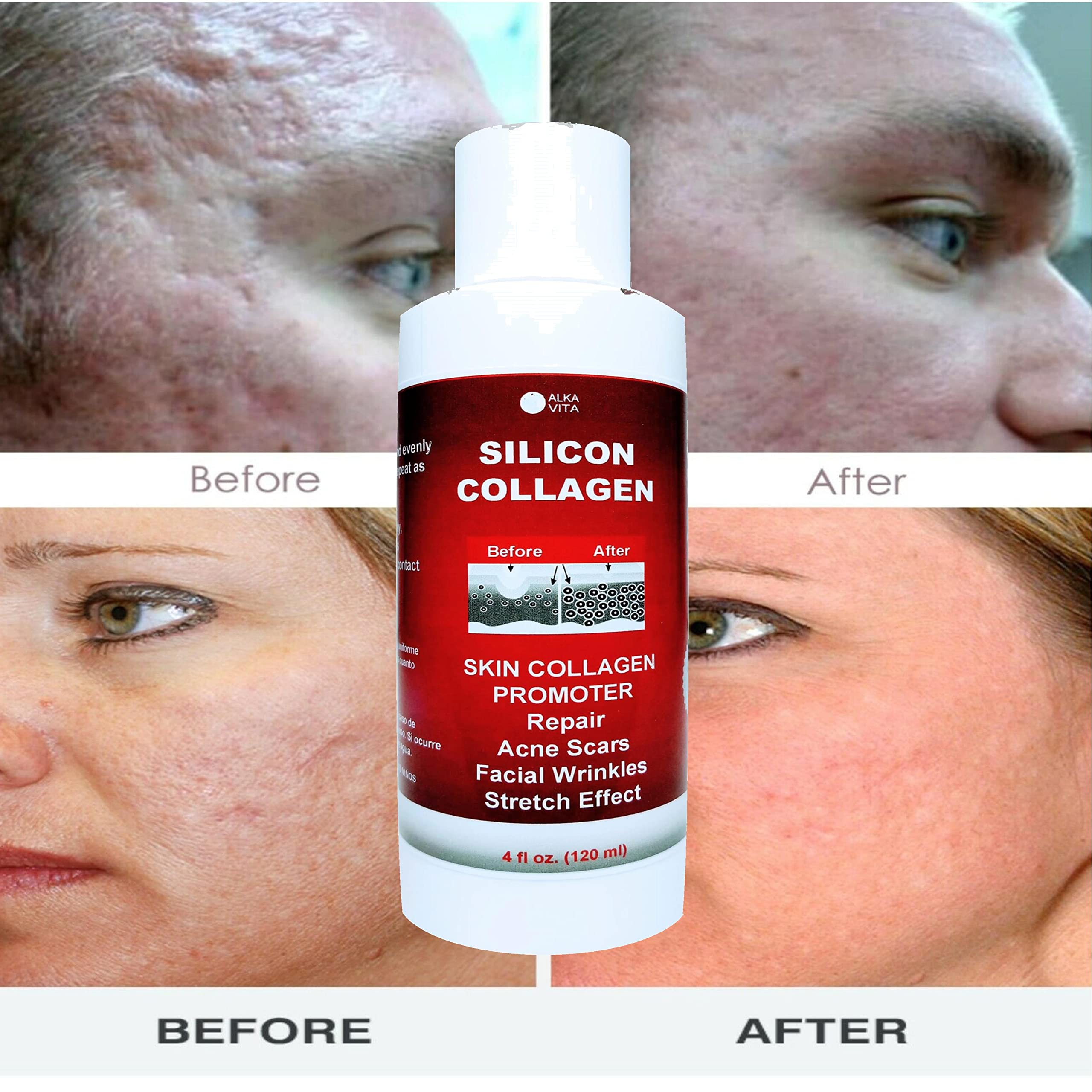 Skin Scars Silicon And Collagen Hydrolyzed Gel Resurfacing Skin Collagen Promoter For Indented Atrophic Rolling Face Scars By Al