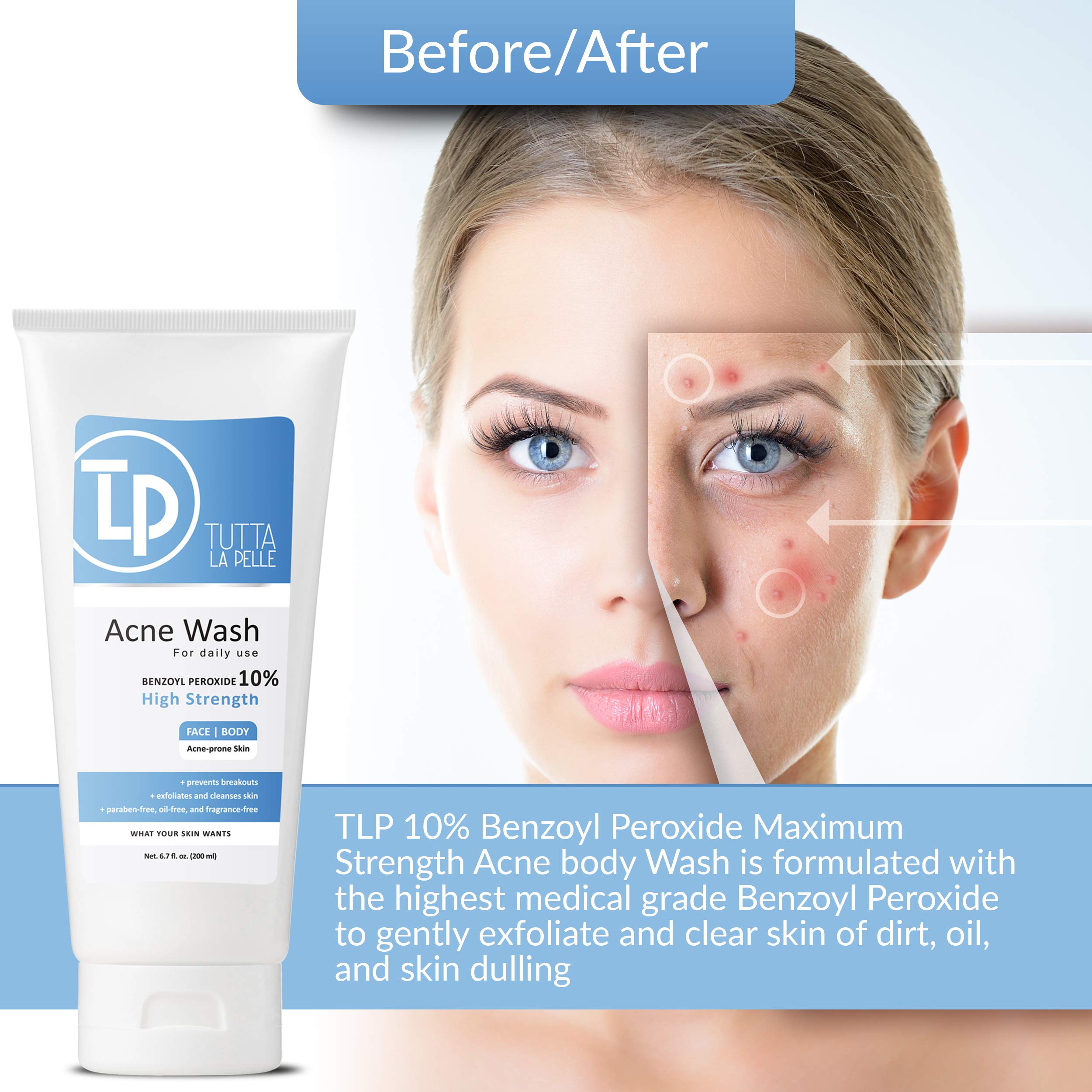 Tutta La Pelle Benzoyl Peroxide Body Wash 10% - Acne Face Wash & Acne Body Wash - Butt Acne Treatment & Back Acne Treatment - Hi