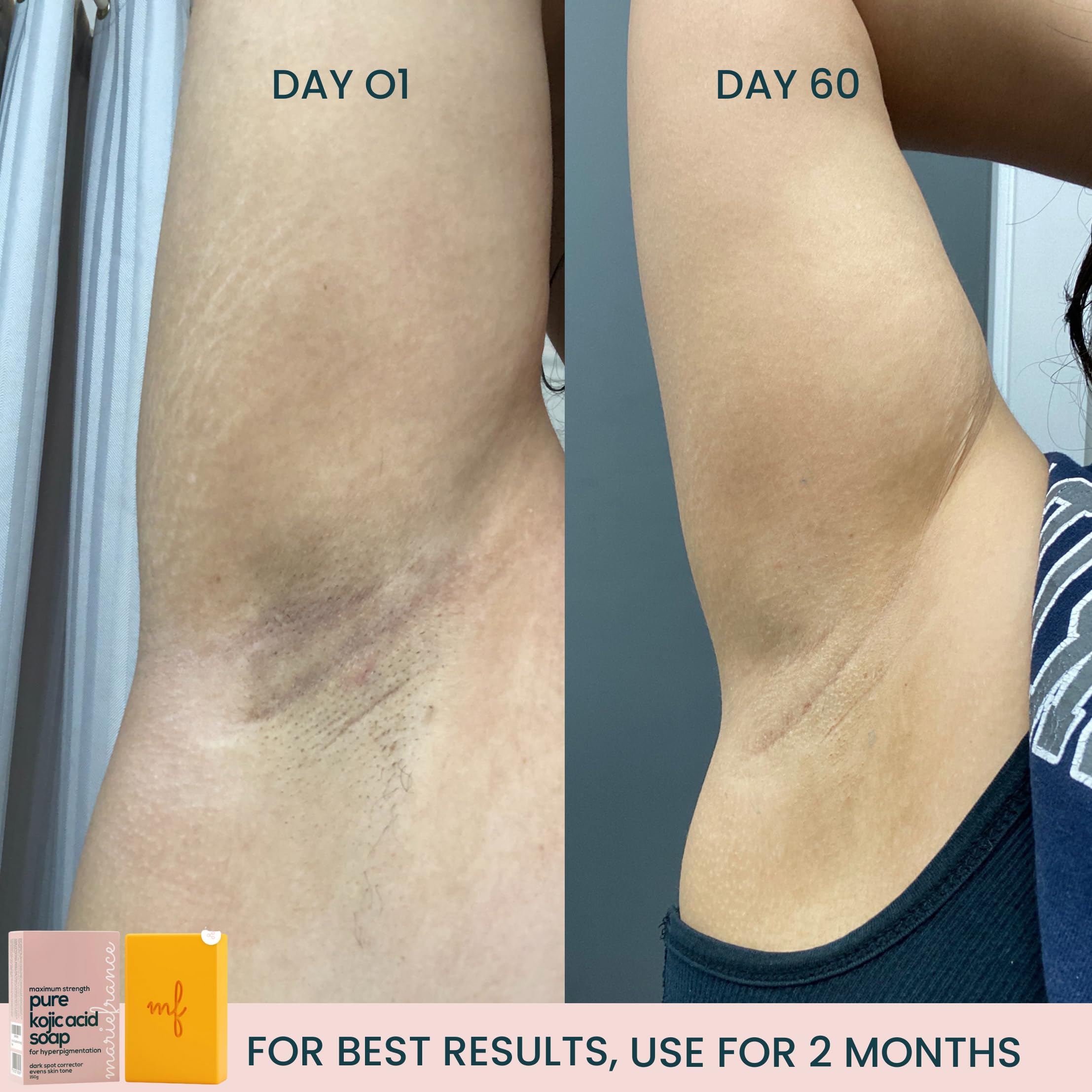 Pure Kojic Acid Soap Bar for Hyperpigmentation and Dark Spots - Dark Spot Remover for Face and Body - For Women with Medium to D