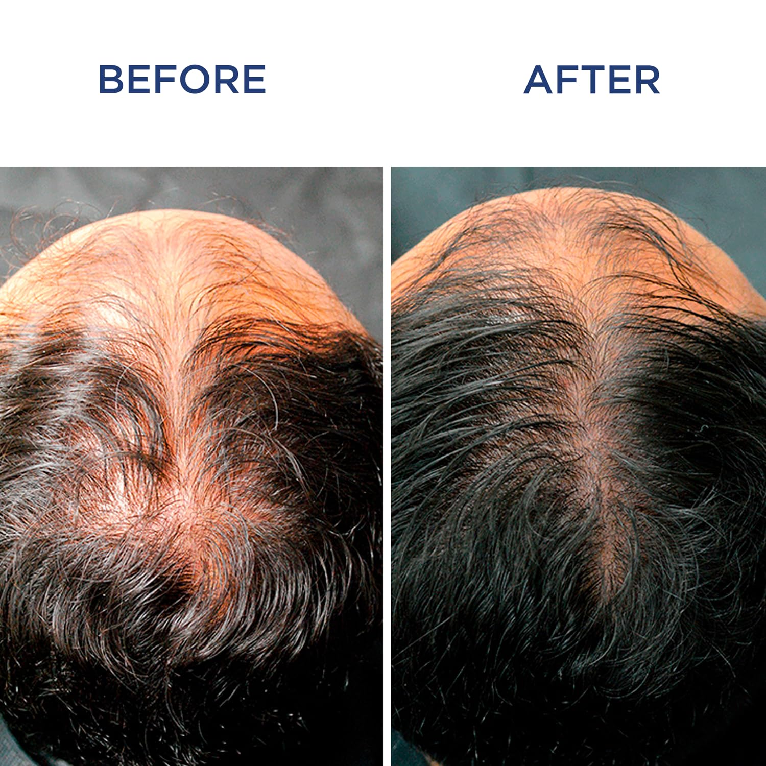 PHYTOCYANE Men Densifying Treatment for Progressive Hair Thinning, Double Efficiency Anti-Fall & Density, 12 Vials x 0.118 fl.oz