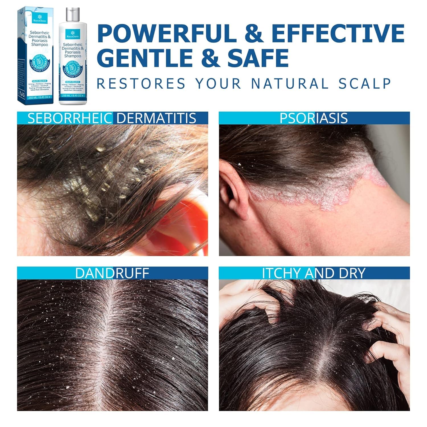 Roycederm Psoriasis Shampoo, Seborrheic Dermatitis Shampoo, Folliculitis Shampoo, Dandruff Shampoo, Scalp Psoriasis & Seborrheic