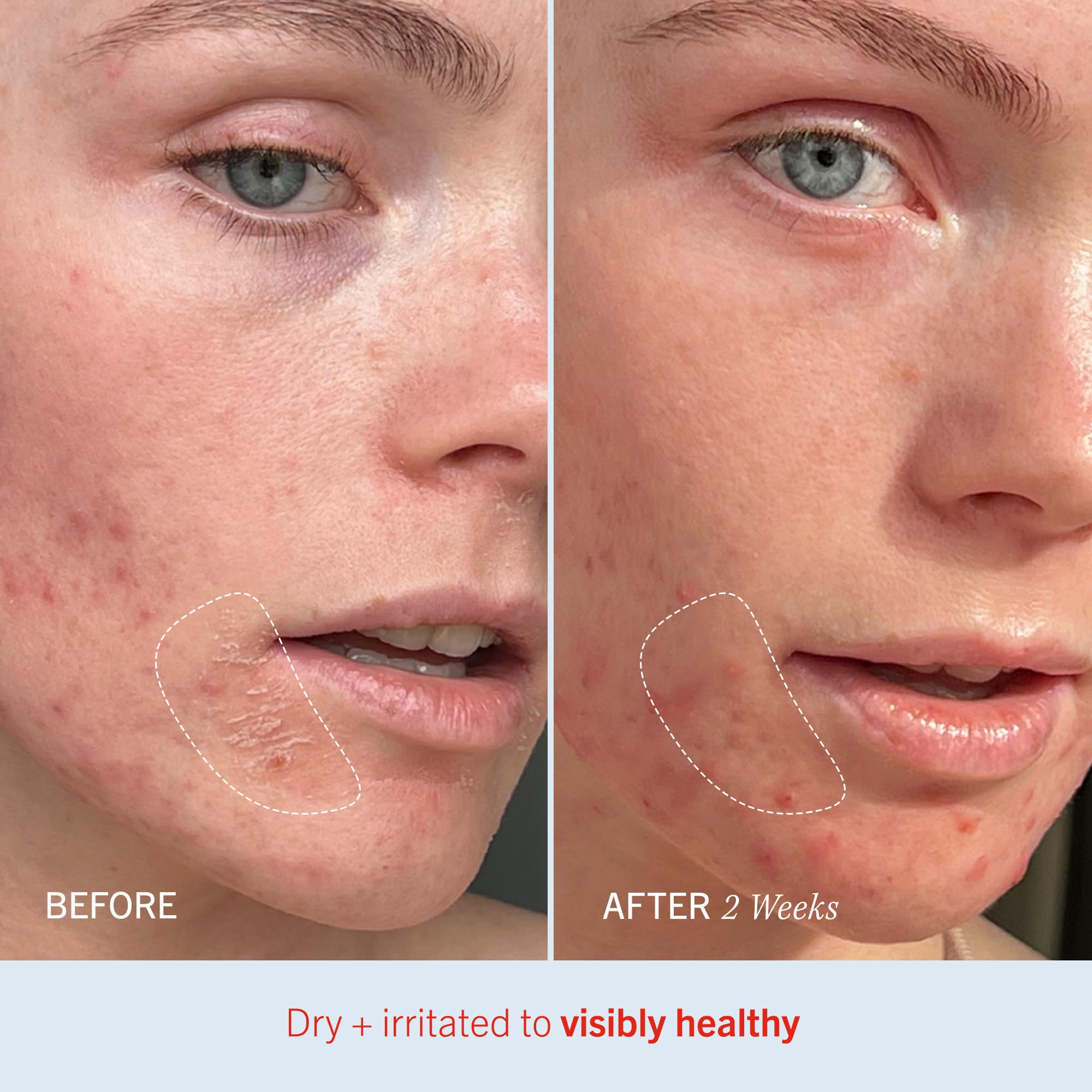 First Aid Beauty By First Aid Beauty Ultra Repair Cream (For Hydration Intense For Dry Parched Skin) --1701G6Oz(D0102H5F1E8)