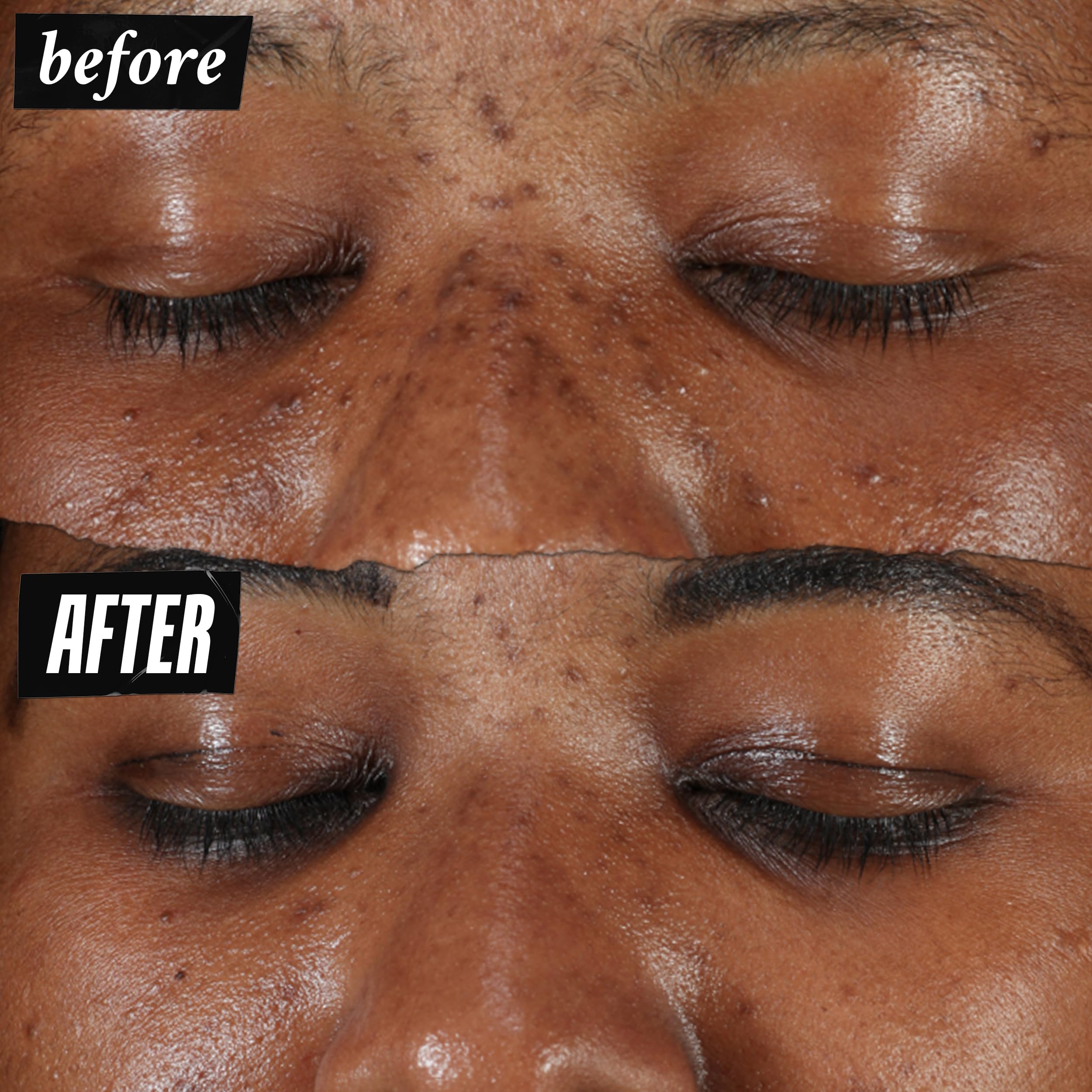 Kiehl'S Clearly Corrective Dark Spot Serum, Brightening Facial Serum, Reduces Hyperpigmentation & Post-Acne Marks, With Vitamin
