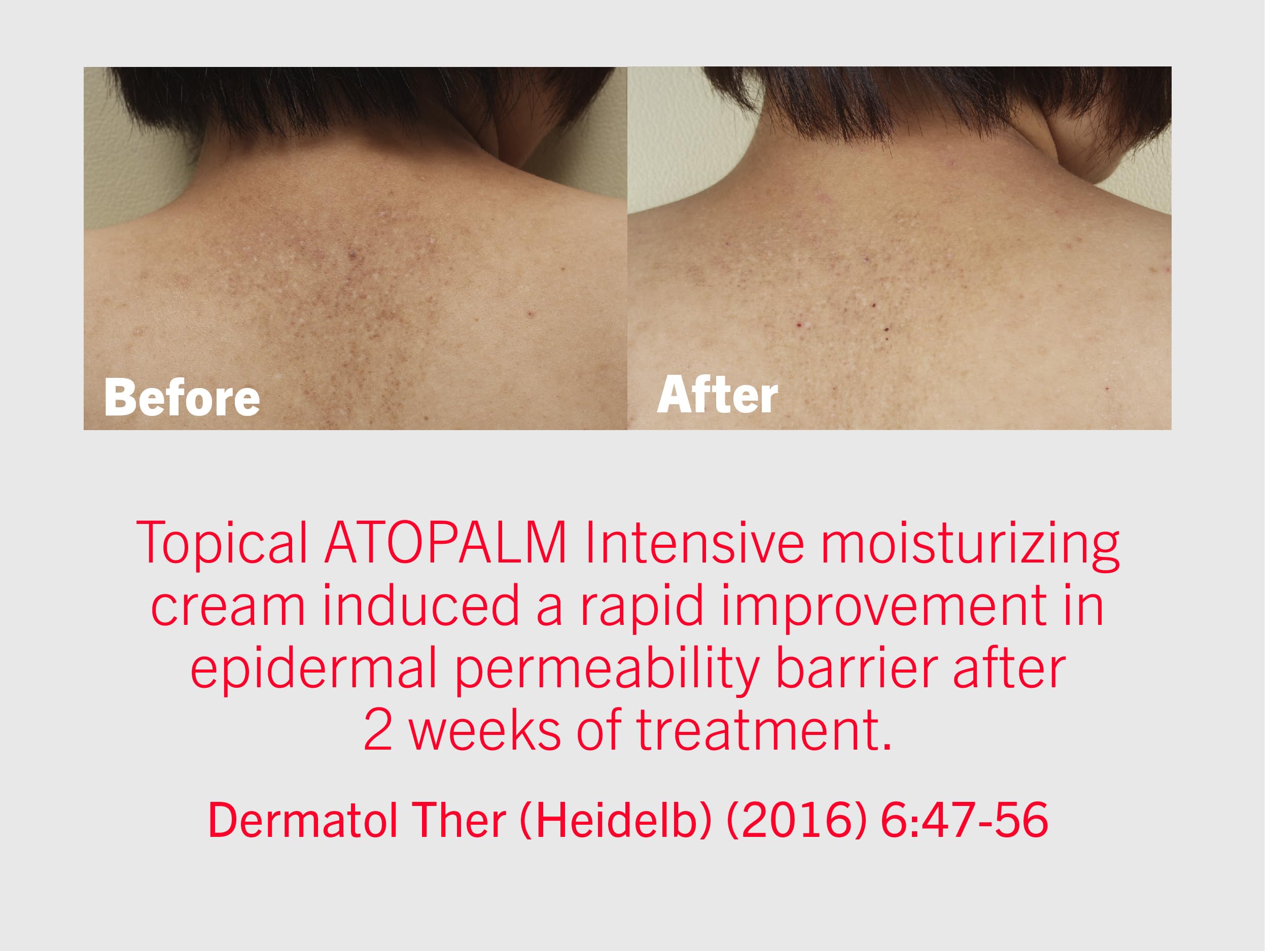 ATOPALM | Intensive Moisturizing Cream | Face & Body Moisturizer | For Dry & Sensitive Skin | Paraben-Free Lotion | Replenishes