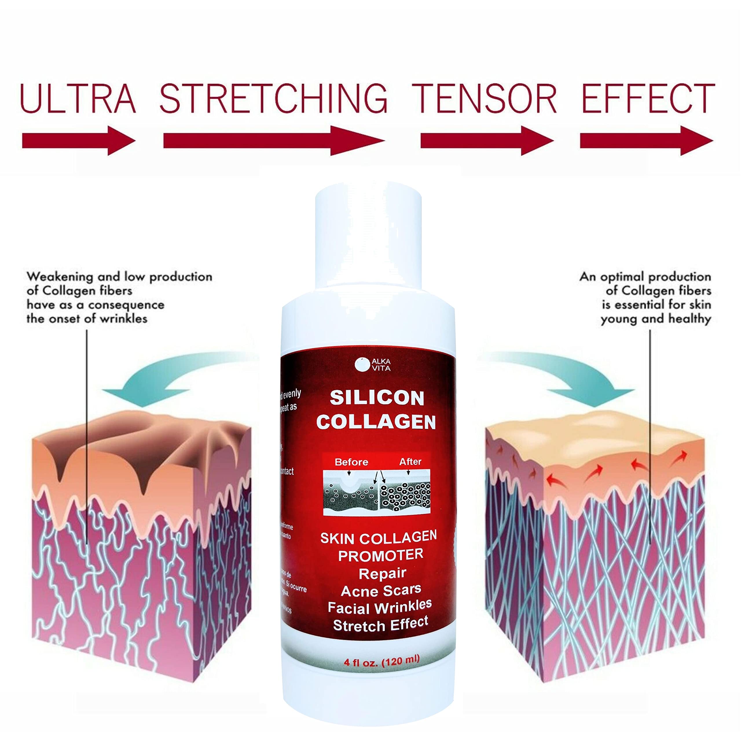 Skin Scars Silicon And Collagen Hydrolyzed Gel Resurfacing Skin Collagen Promoter For Indented Atrophic Rolling Face Scars By Al