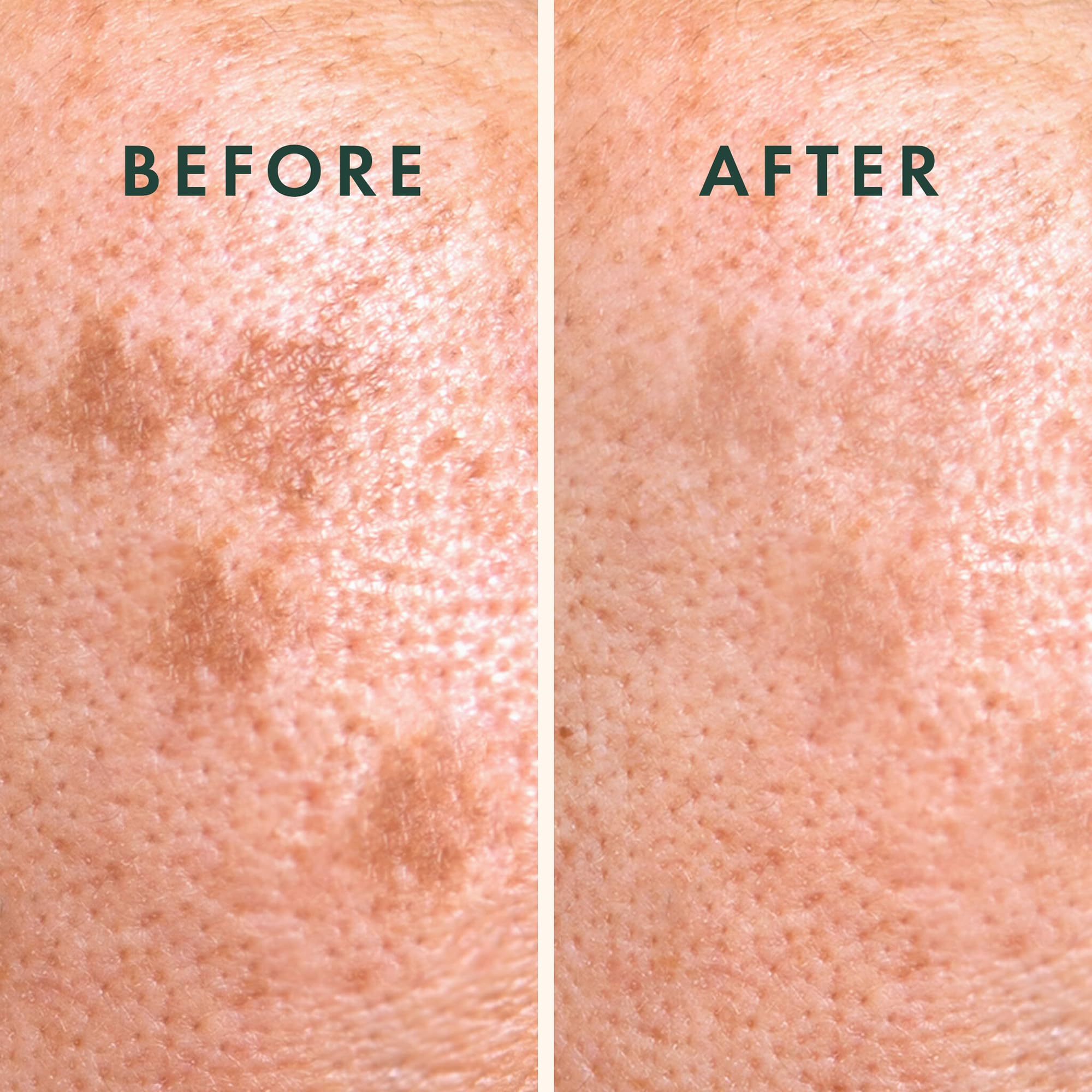 Rael Miracle Microcrystal Dark Spot Cover - Hydrocolloid, Post Acne Dark Spots, Skin Care, With Skin Brightening Ingredients (6