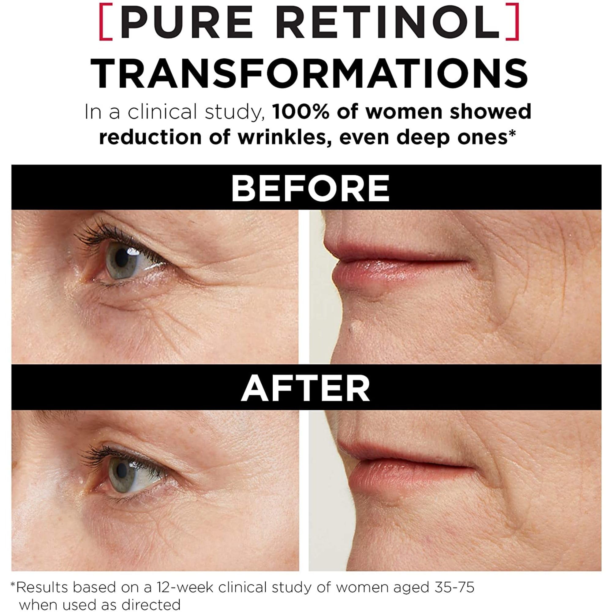 'L'Oreal Paris Revitalift Triple Power LZR Retinol Night Serum For Face, With 0.3% Pure Retinol, Moisturizes Skin and Eliminates