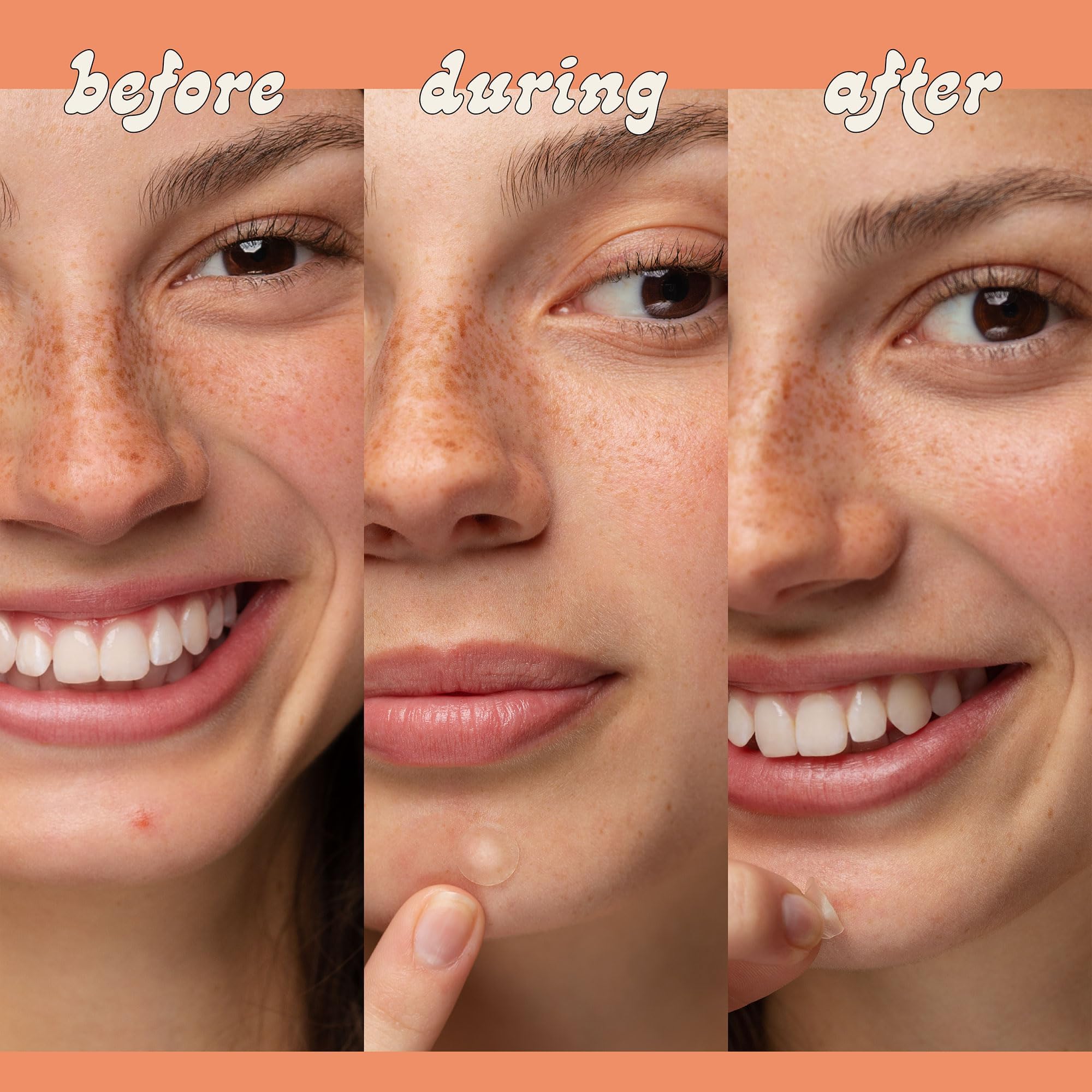 Lespot Pimple Patches For Face - Effective & Invisible Hydrocolloid Acne Patches For Covering Zits & Blemishes, Zit Patches For