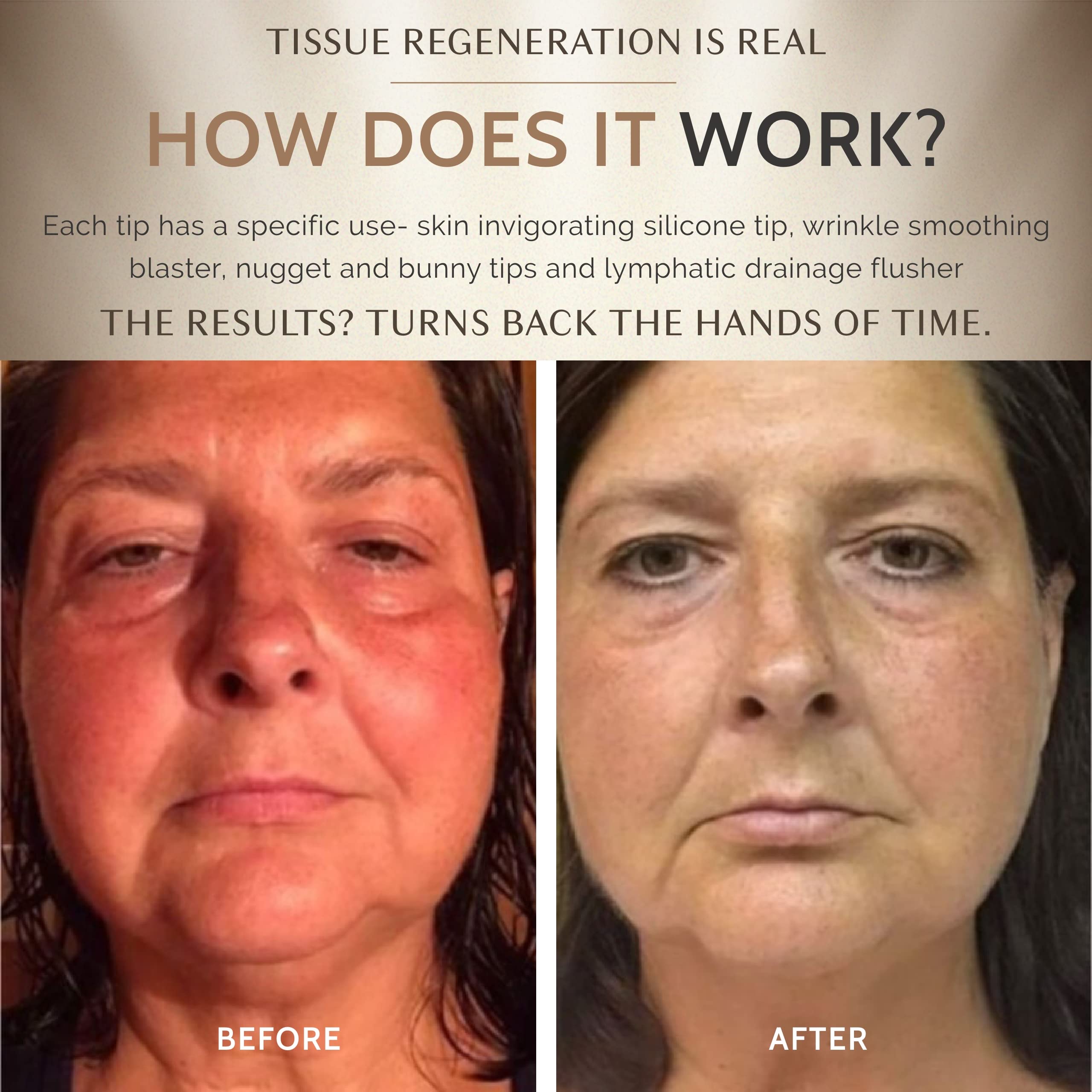 The Omg Blaster 5-In-1 Face Lifting Tool By Ashley Black. Patented Technology For Fine Lines, Wrinkles, Skin Tightening, Face Co