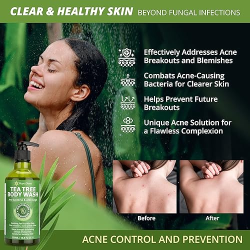 Roycederm Antifungal Body Wash - Tea Tree, 16.9 Fl Oz, Green - For Acne, Tinea Versicolor, Jock Itch, Athlete's Foot, Body Odor