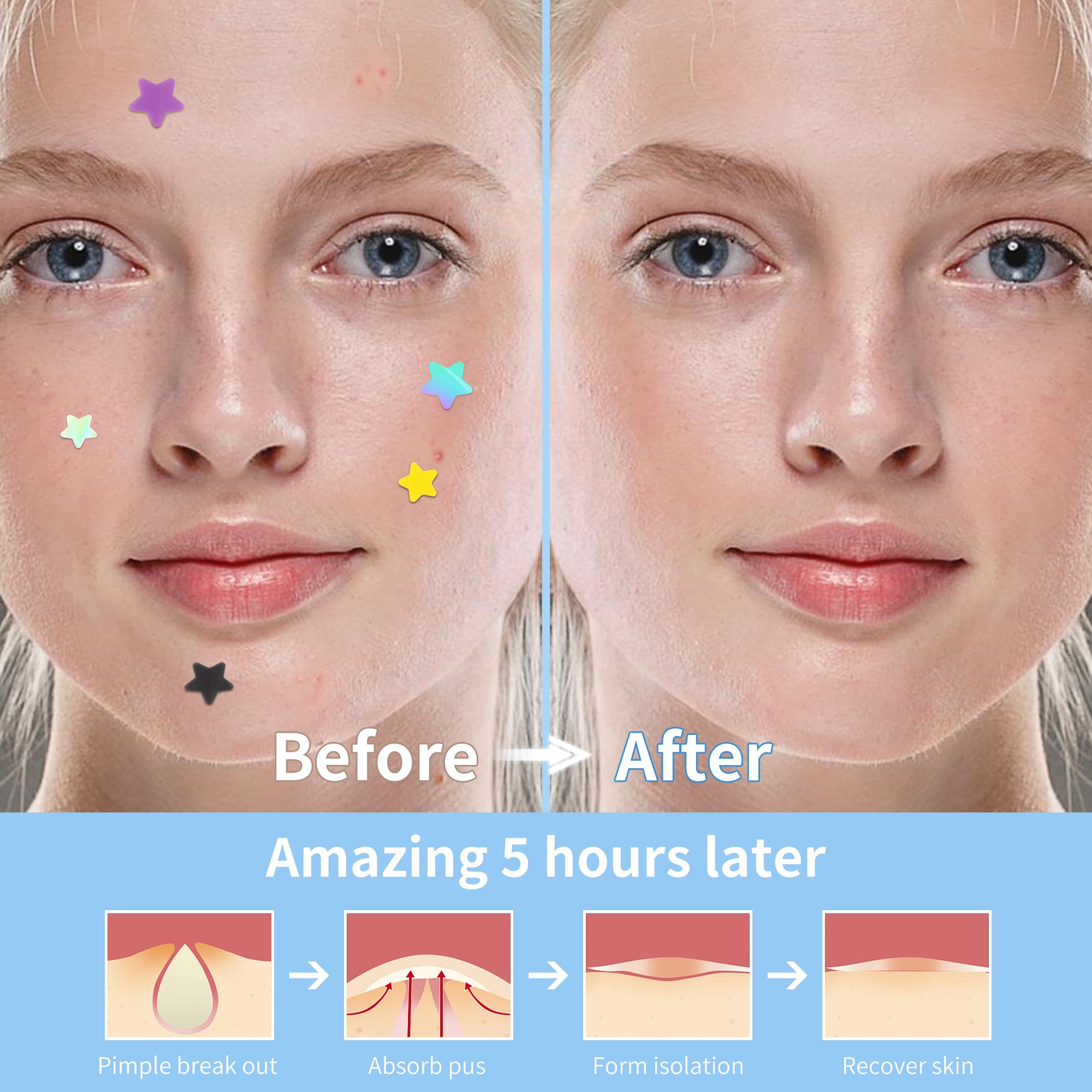 Daolyo Pimple Patches For Face, 3 Size 280 Counts Acne Patches, Cute Star Pimple Patches With Salicylic Acid, Tea Tree Oil & Cal