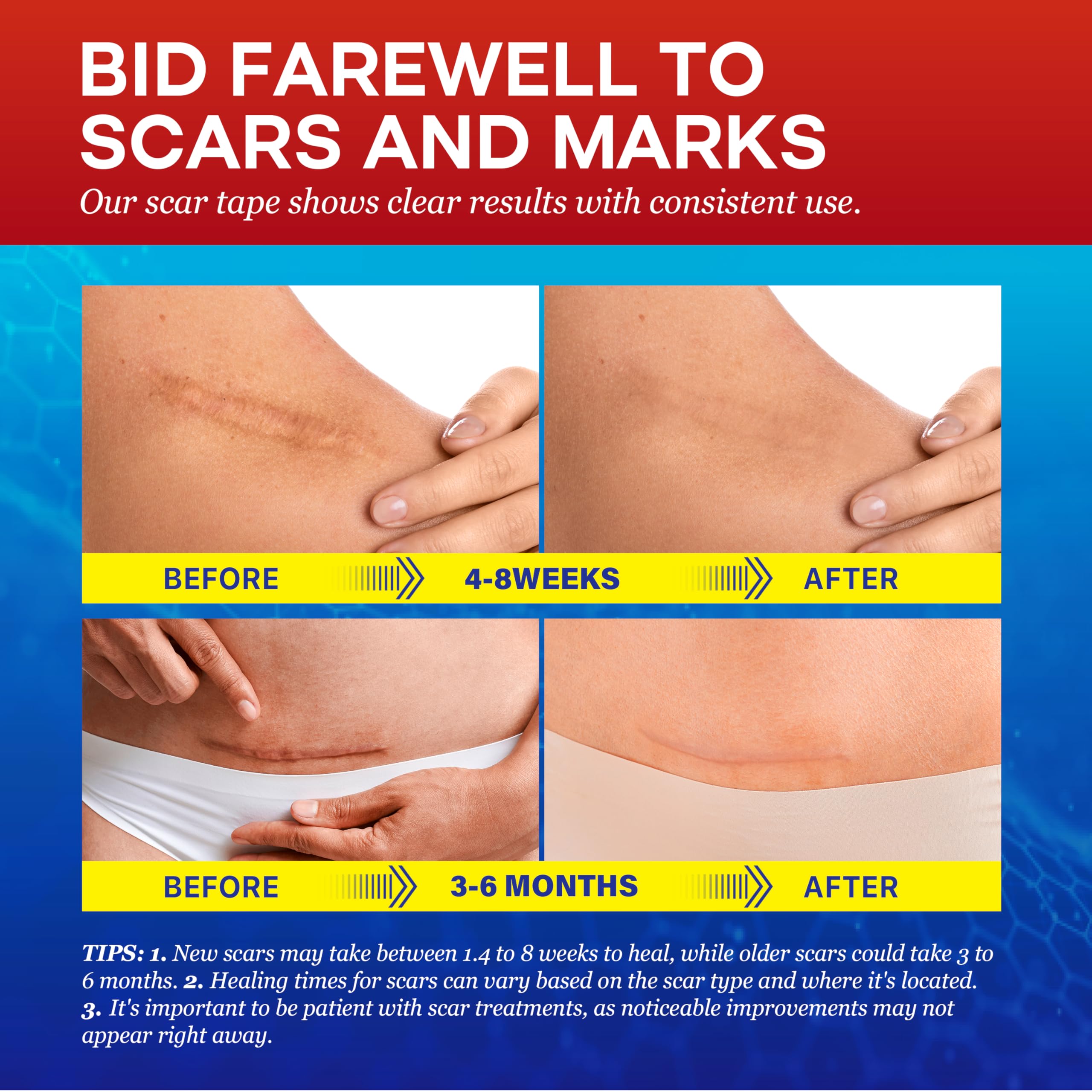 1.6''X 120'' Medical Silicone Scar Tape For Scars: Medical Grade Scar Sheets Reduces The Appearance Of Scars From Surgical Acne