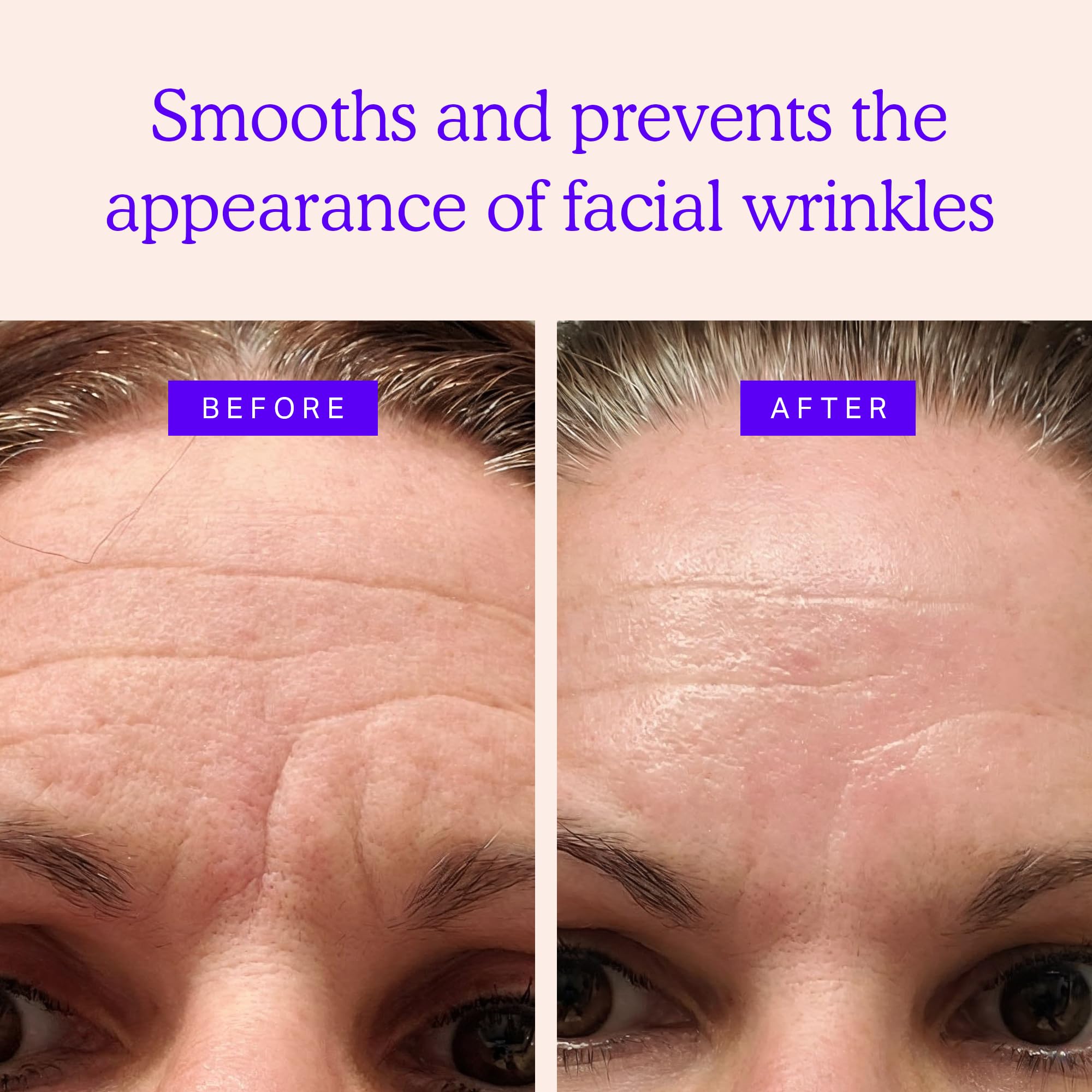 Blumbody Face & Forehead Wrinkle Patches - Mini Anti Wrinkle Facial Patches To Smooth Eye, Mouth, Forehead Wrinkles - Non-Silico