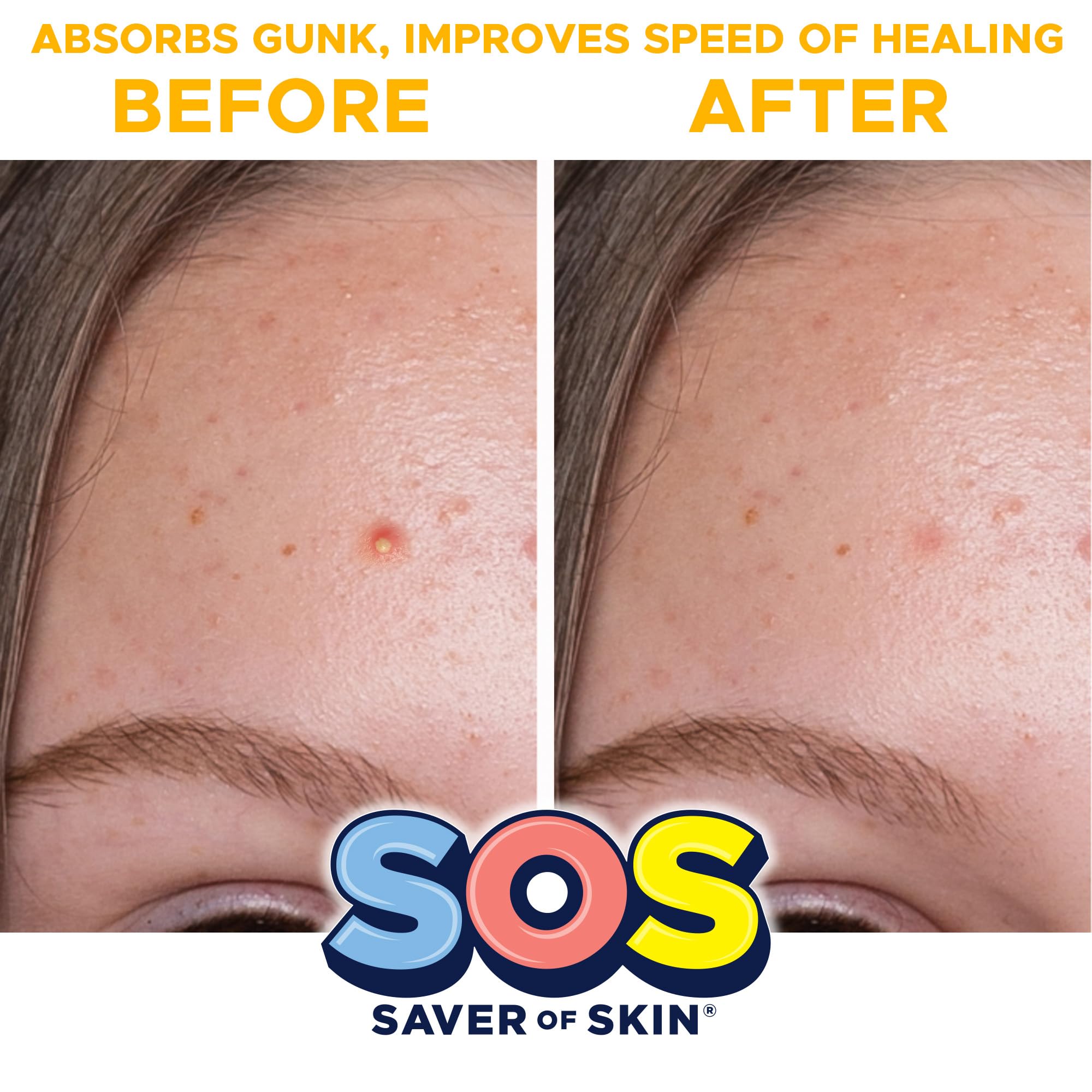 Sos Saver Of Skin Fun Shape Blemish Patches - Fast Acting Hydrocolloid For Pimples, Zits, Acne, And Face Blemishes - Latex-Free