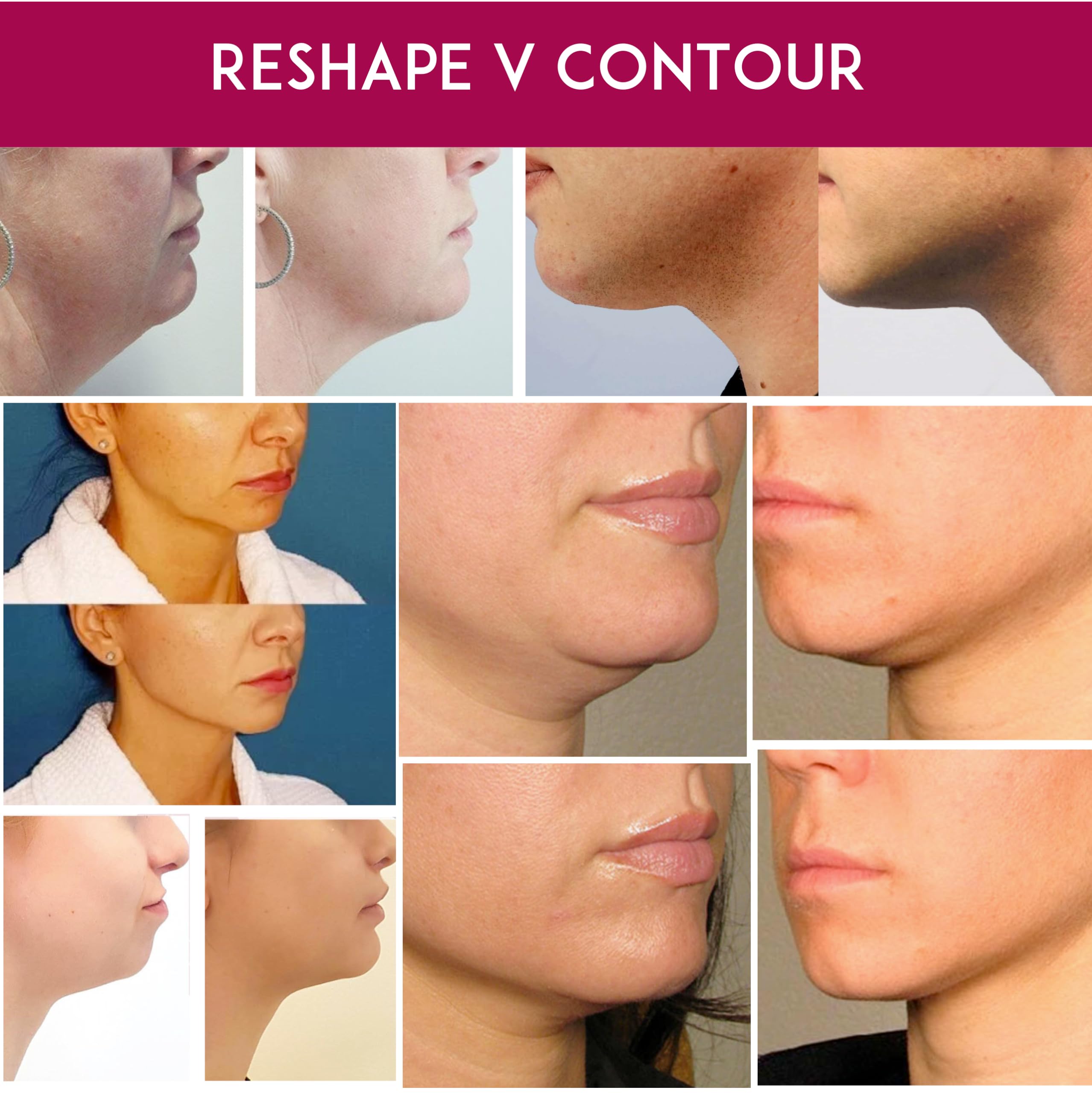 Anacis Facial Mask - Works for V-line Neck Chin Jawline - Fine Lines - Neck Wrinkles - Sagging Skin - for Women and Men - 5 Face