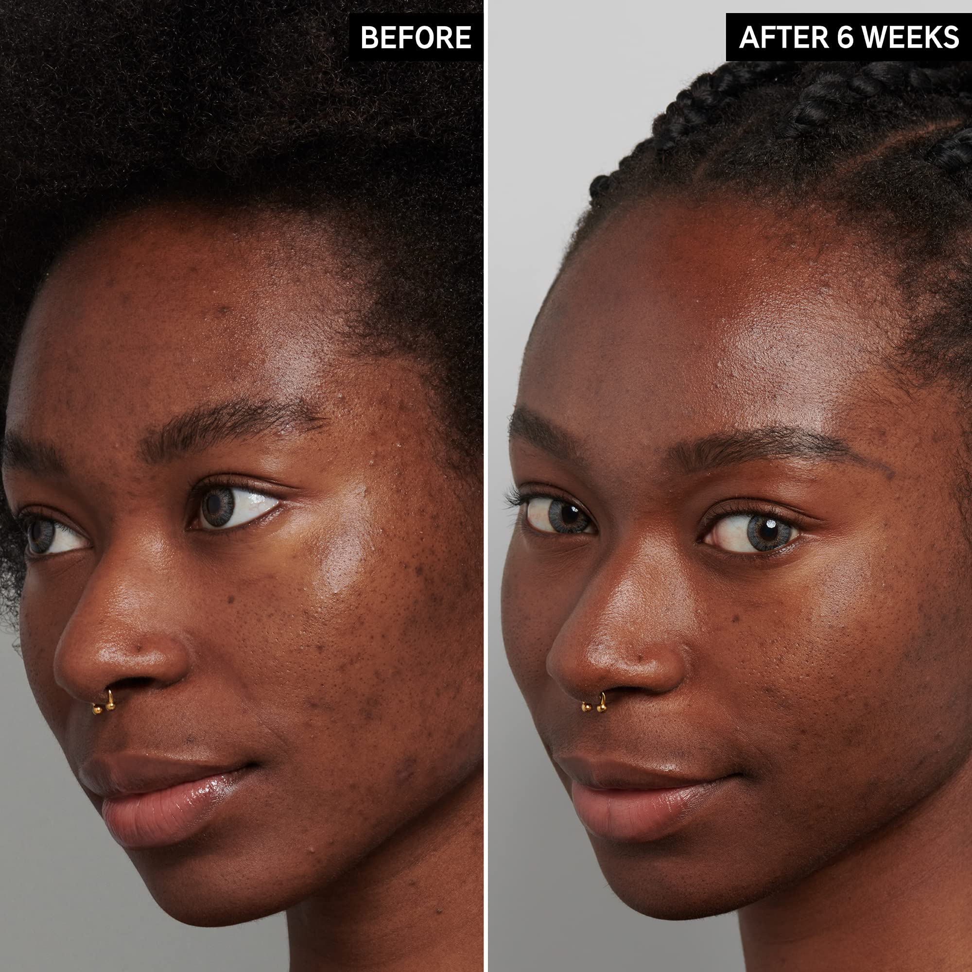 The INKEY List Tranexamic Acid Serum, Helps Reduce Appearance of Skin Discoloration, Dark Spots and Uneven Patches, Healthy-Look