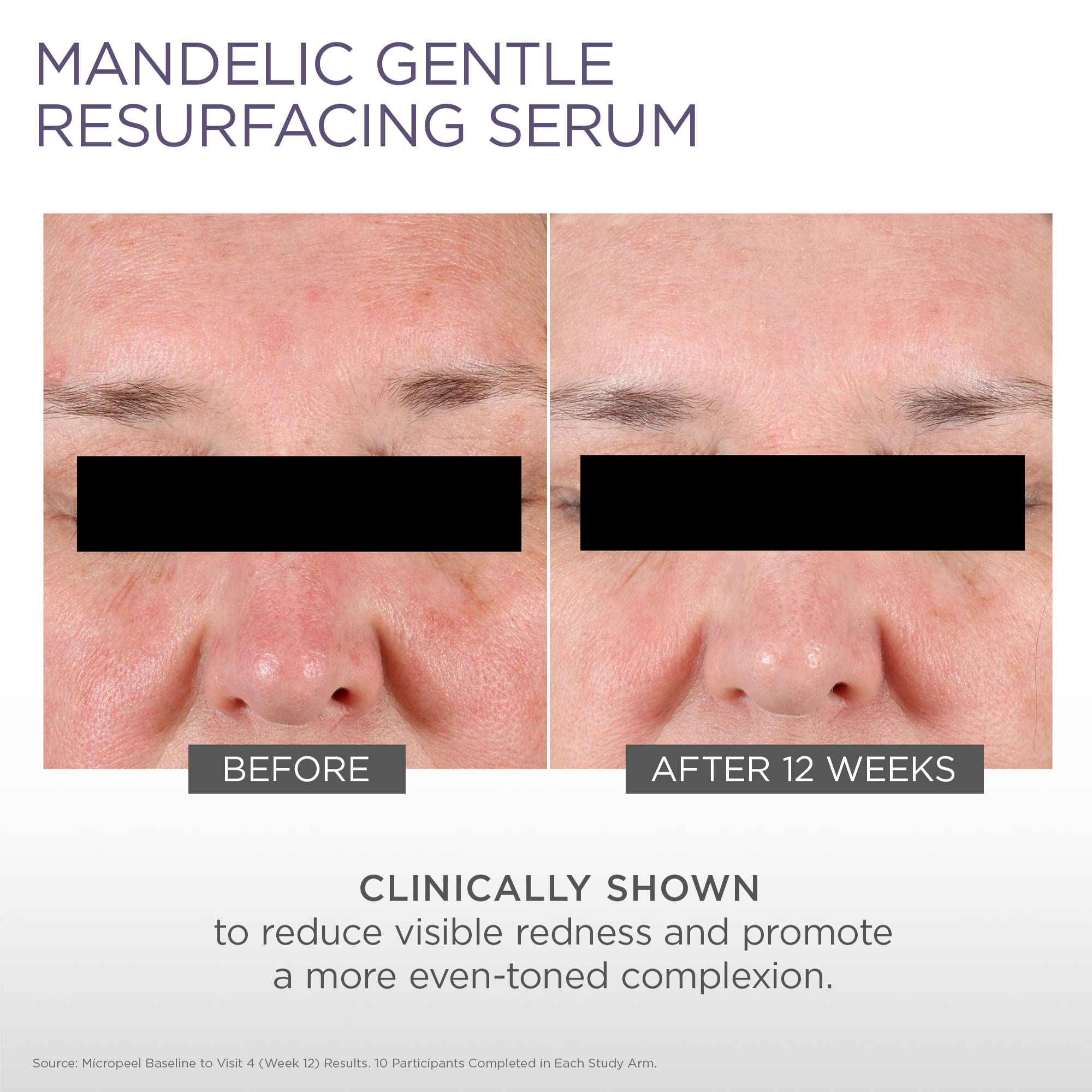 Glytone Micro-Peel Mandelic Gentle Resurfacing Serum - With 10% Mandelic Acid - For Redness-Prone Skin - Vegan, Paraben & Fragra