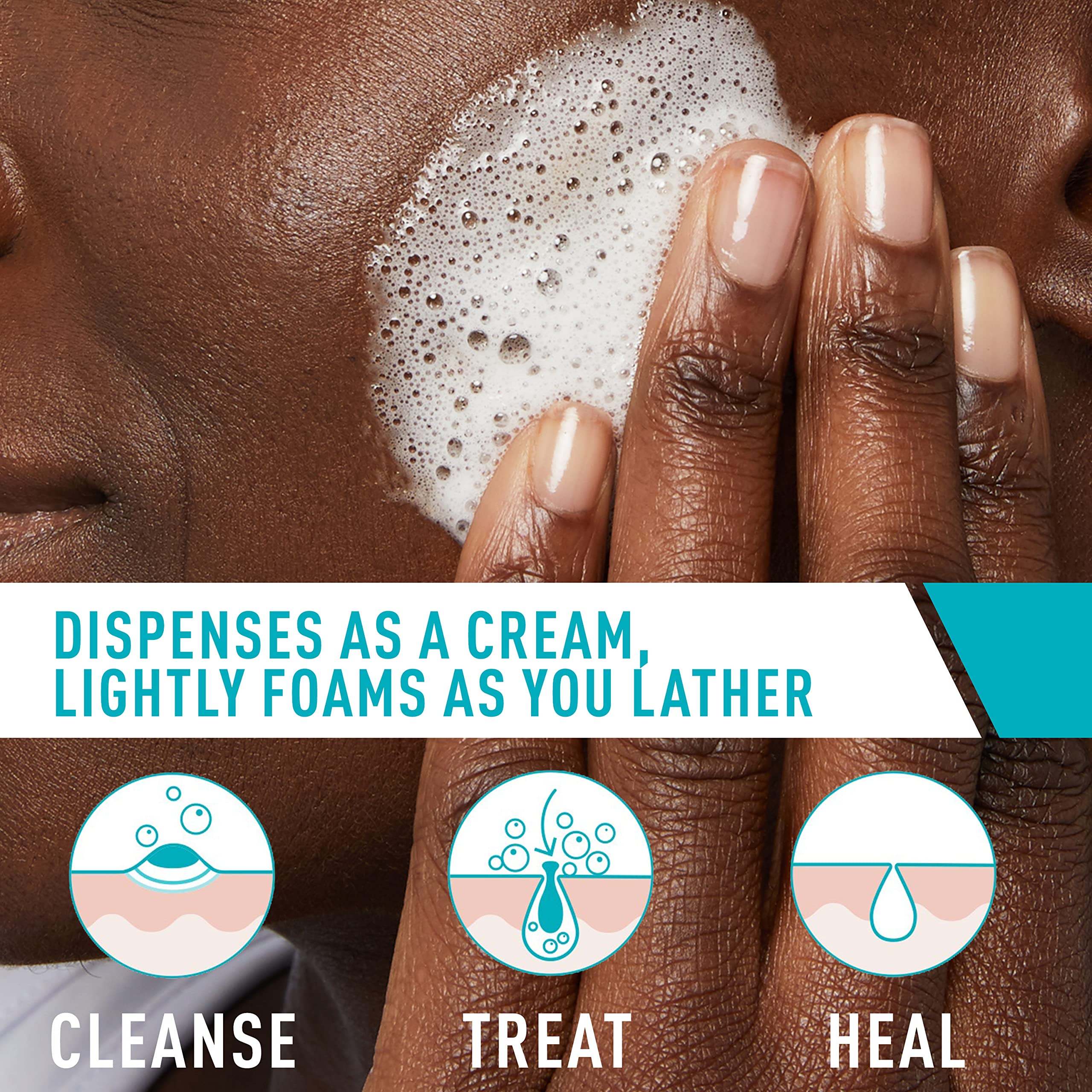 Cerave Acne Foaming Cream Cleanser | Acne Treatment Face Wash With 4% Benzoyl Peroxide, Hyaluronic Acid, And Niacinamide | Cream