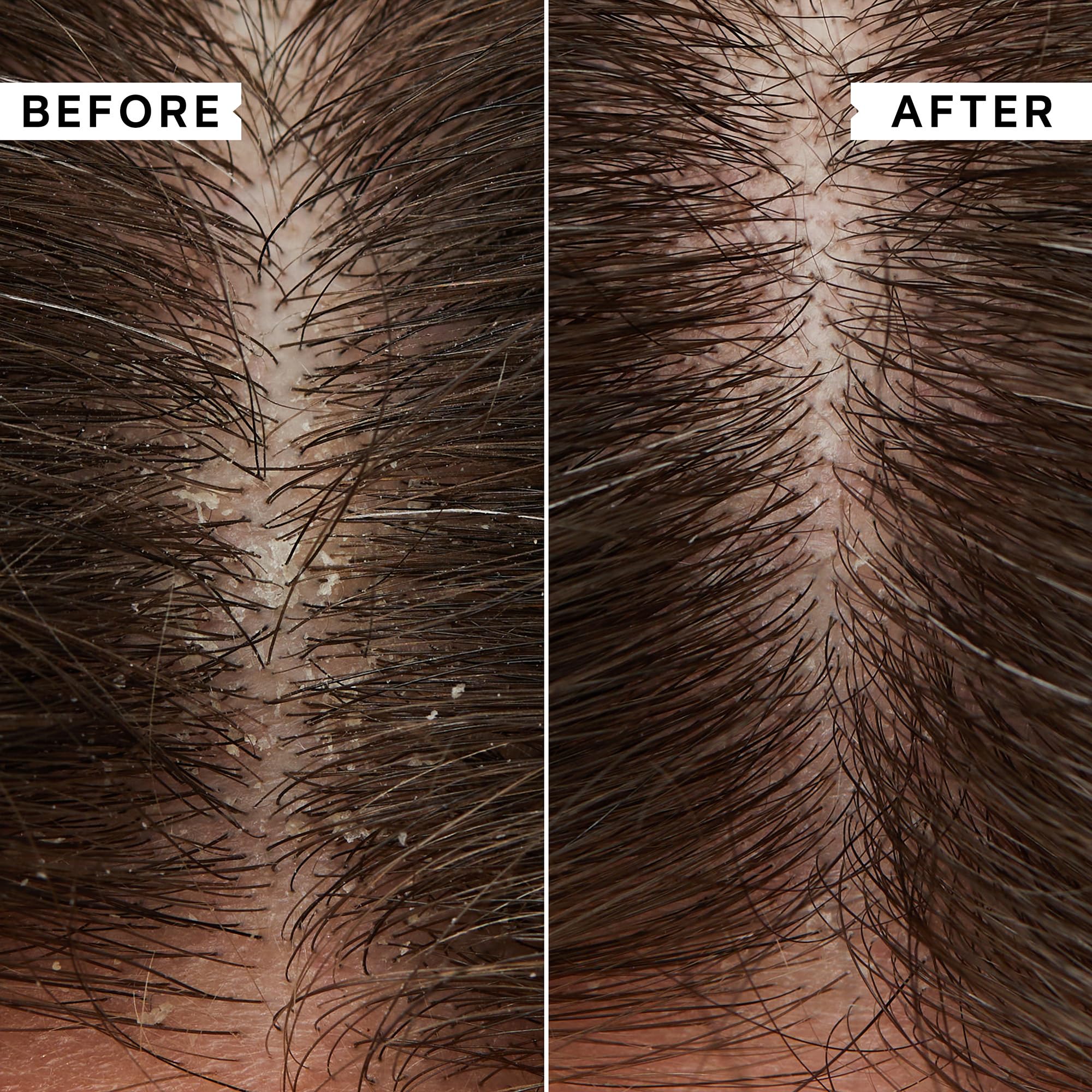 PHILIP KINGSLEY | Flaky Scalp Shampoo | Shampoo For Flaky, Itchy, Dry, Oily Scalps | Cleansing Scalp Care | Hair Shampoo that Hy